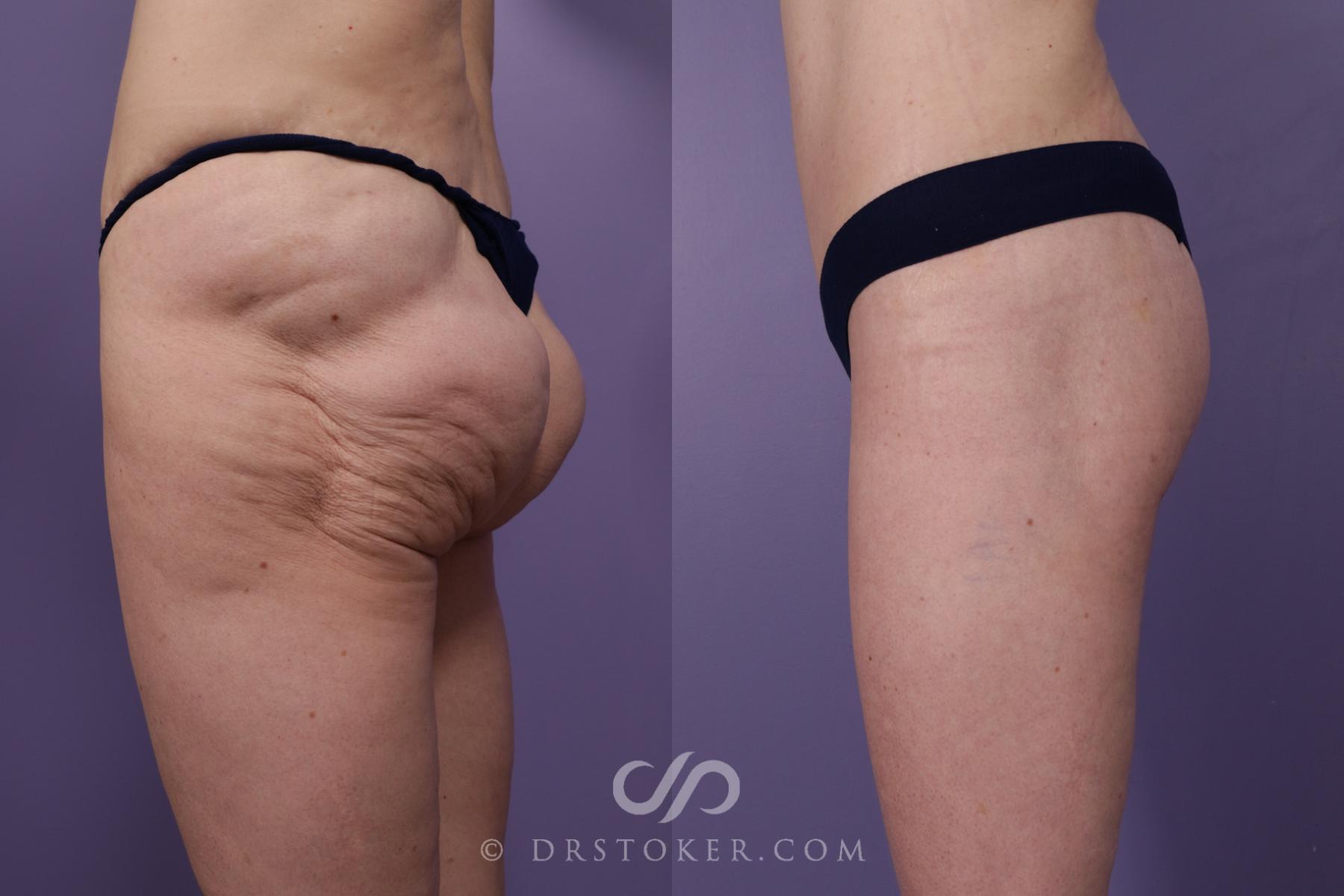 Before & After Thigh lift Case 1832 Left Side View in Los Angeles, CA
