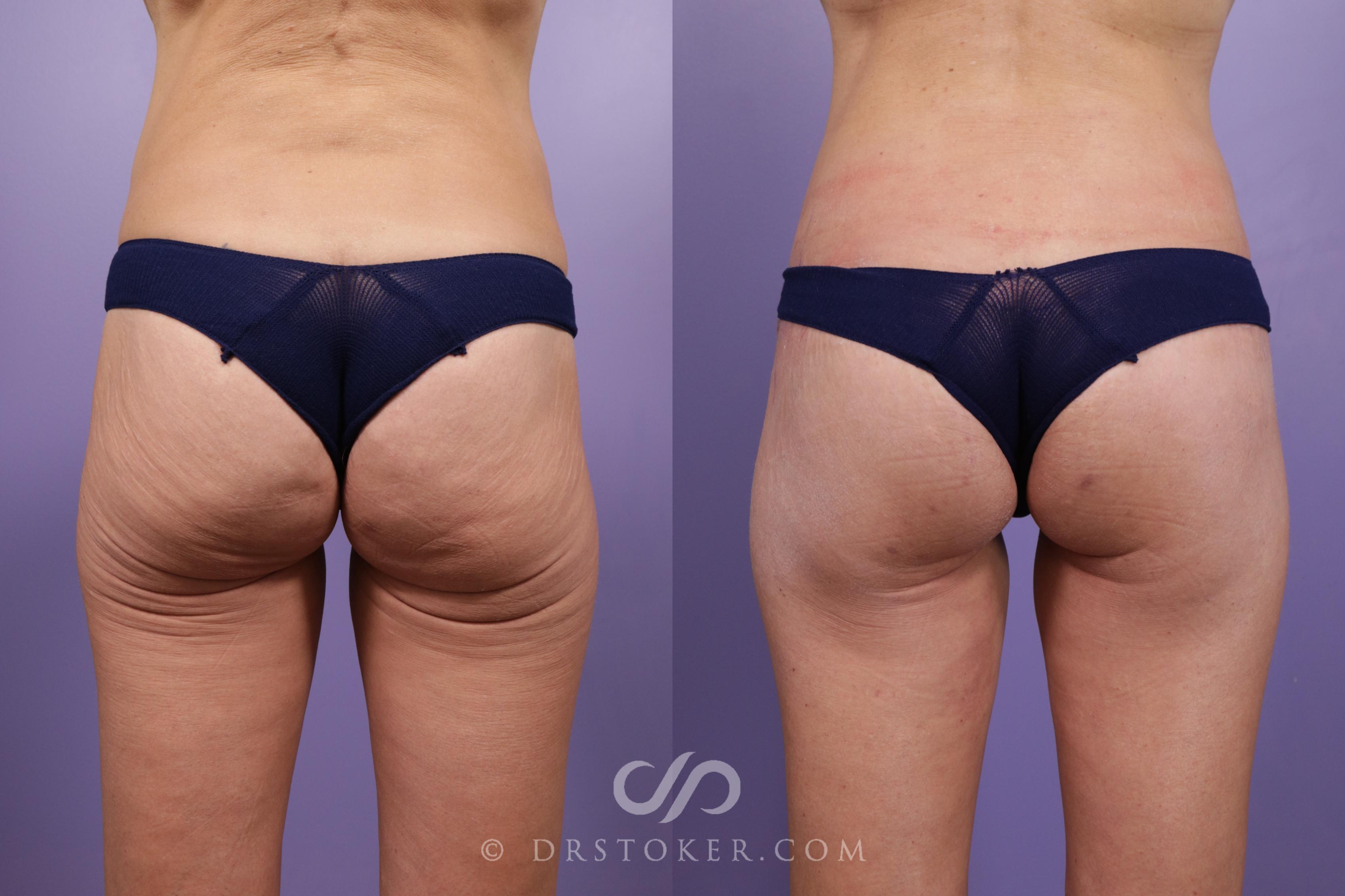 Before & After Thigh lift Case 1835 Back View in Los Angeles, CA