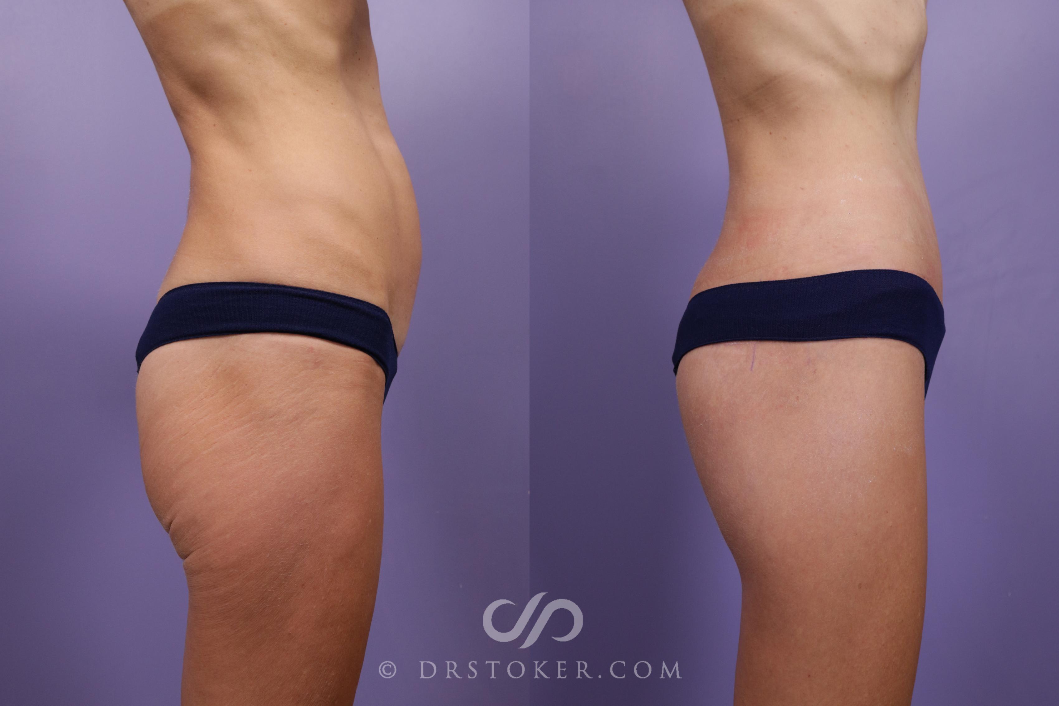 Before & After Thigh lift Case 1835 Right Side View in Los Angeles, CA