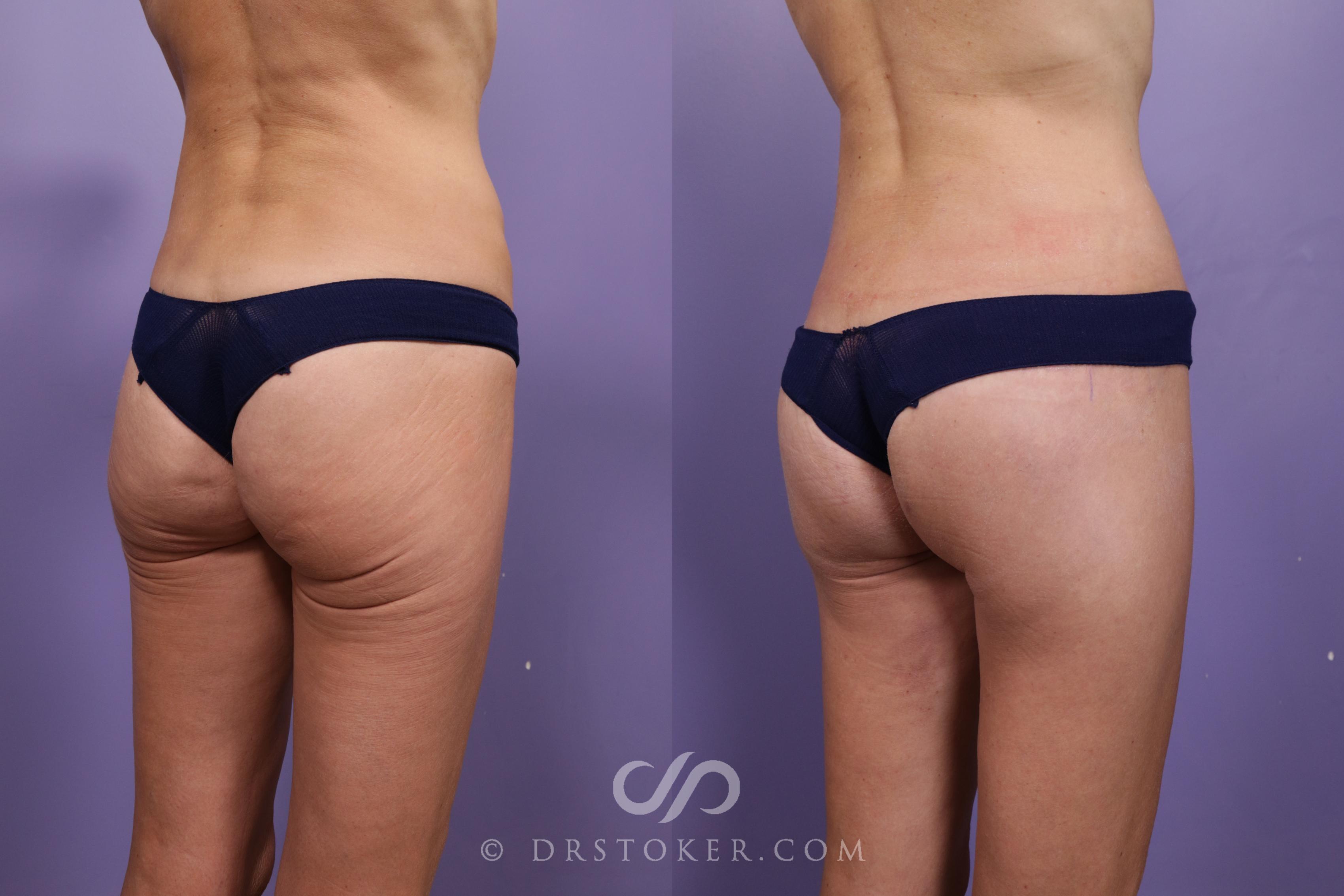 Before & After Thigh lift Case 1836 Right Oblique View in Los Angeles, CA