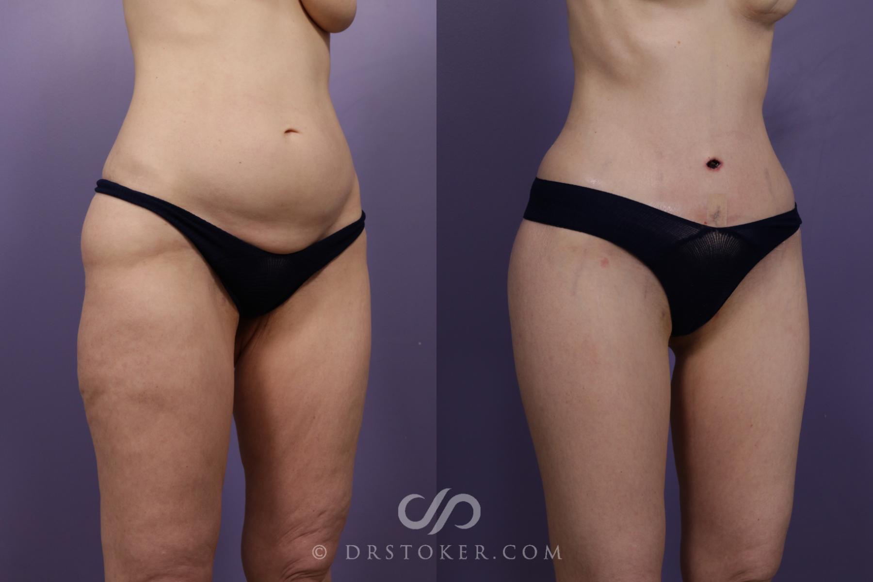 Before & After Thigh lift Case 1839 Right Oblique View in Los Angeles, CA