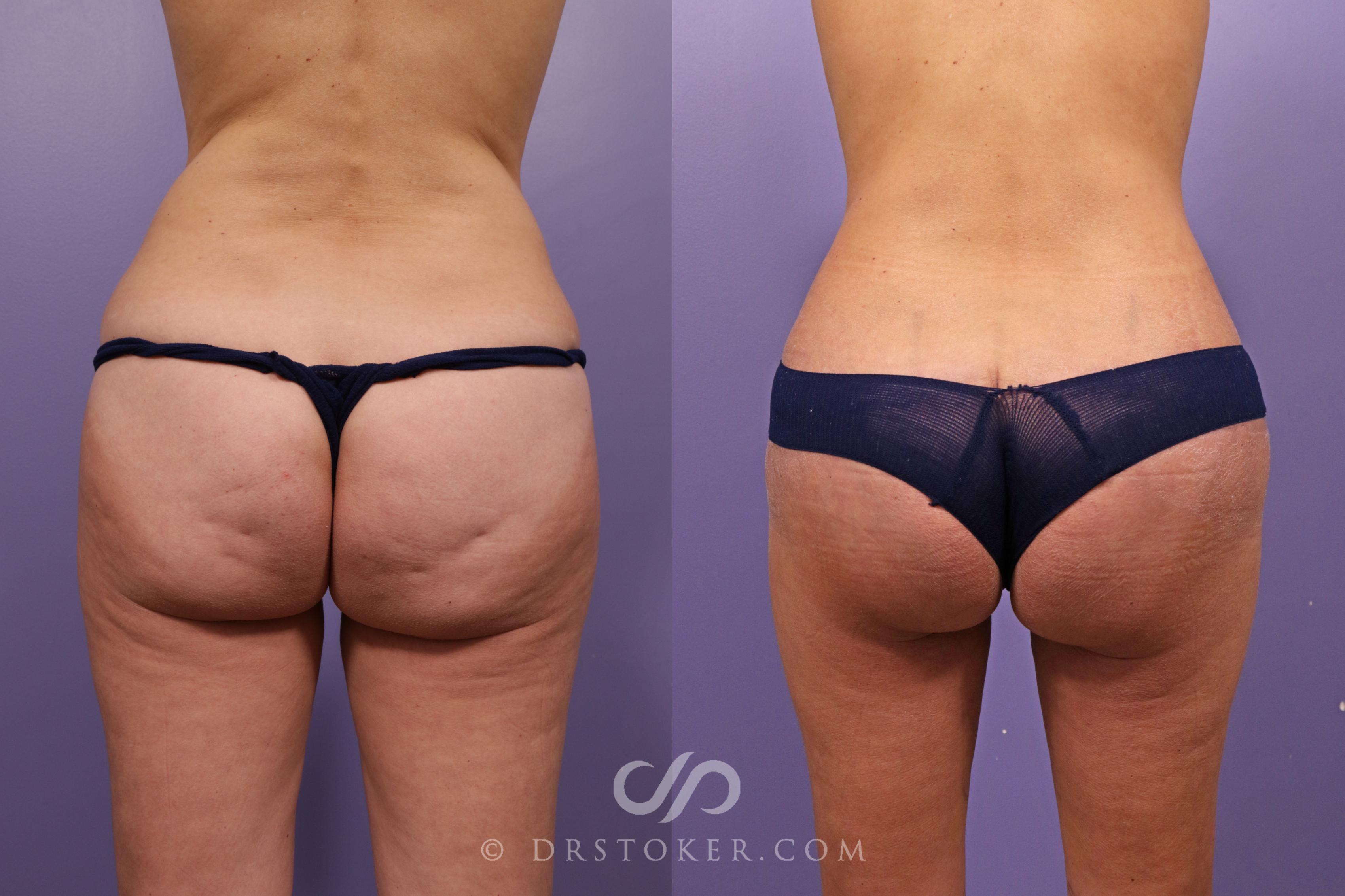 Before & After Thigh lift Case 1841 Back View in Los Angeles, CA