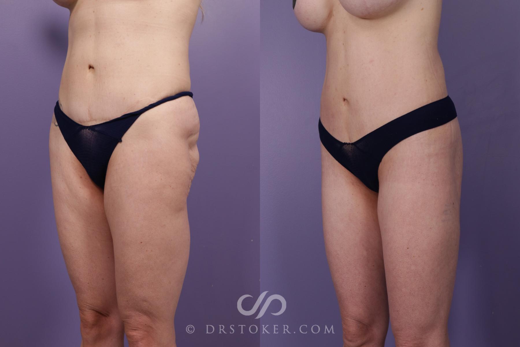 Before & After Thigh lift Case 1846 Left Oblique View in Los Angeles, CA