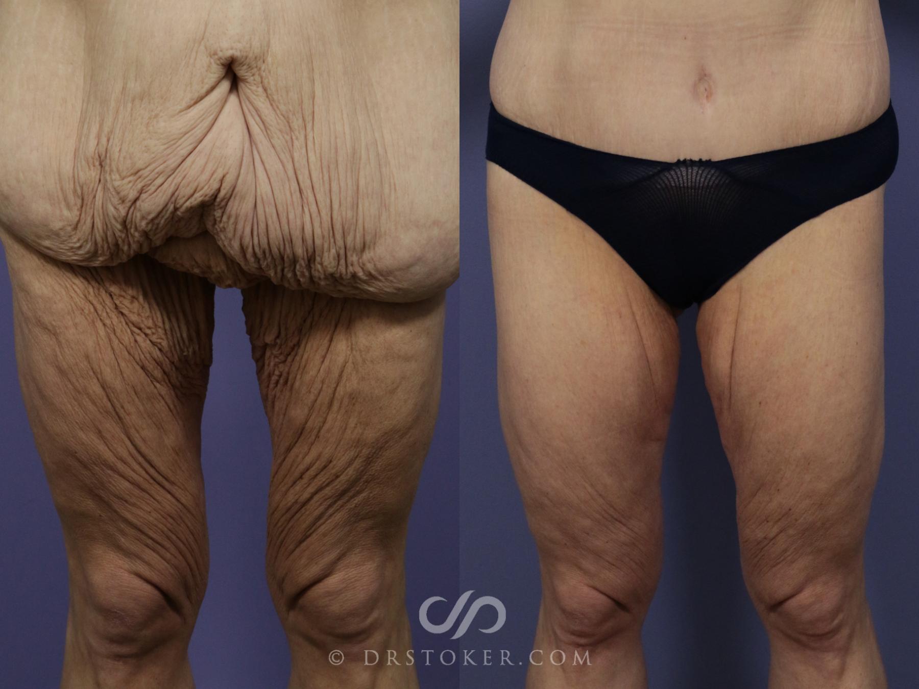 Before & After Thigh lift Case 1847 Front View in Los Angeles, CA