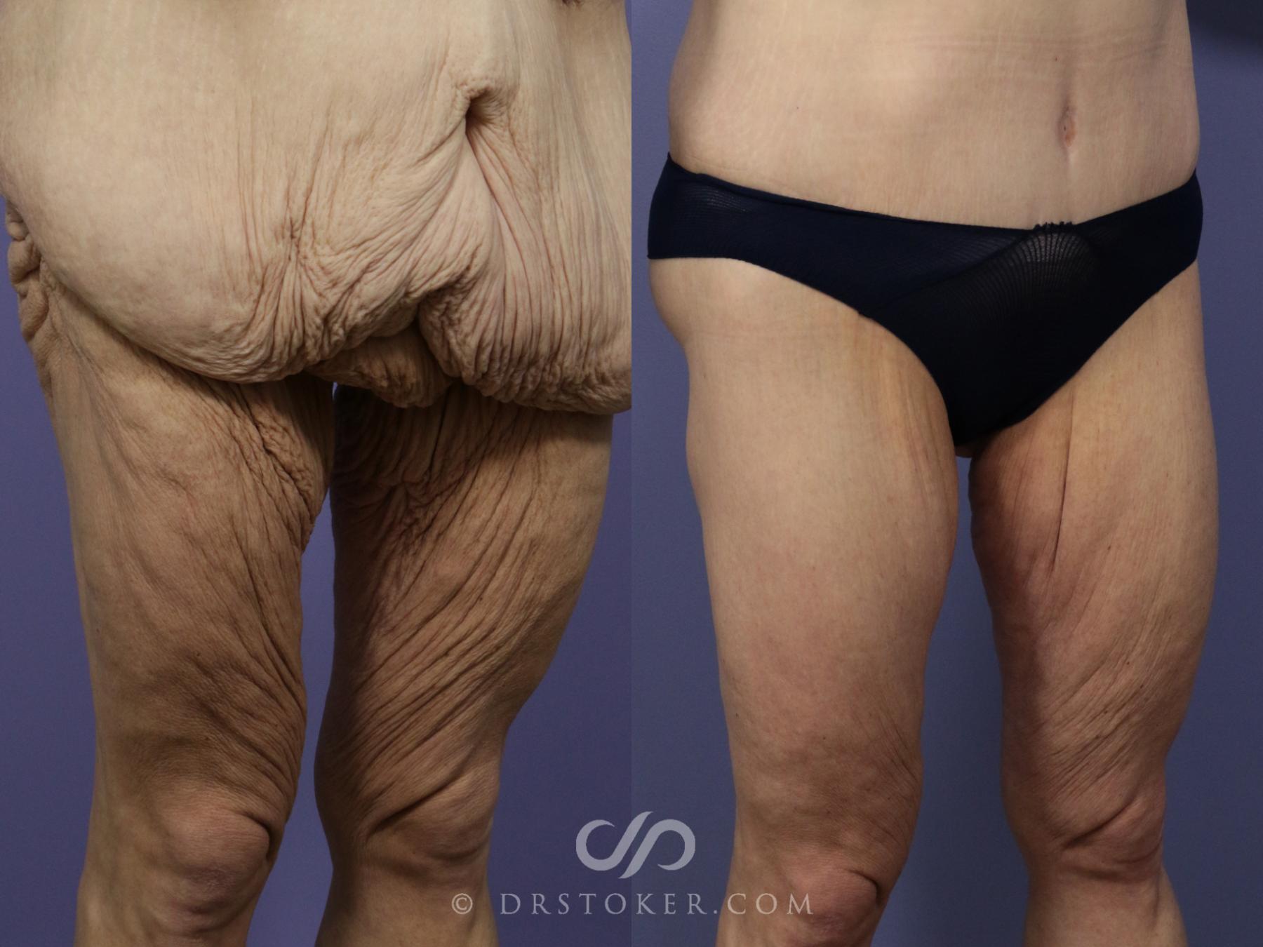 Before & After Thigh lift Case 1847 Right Oblique View in Los Angeles, CA