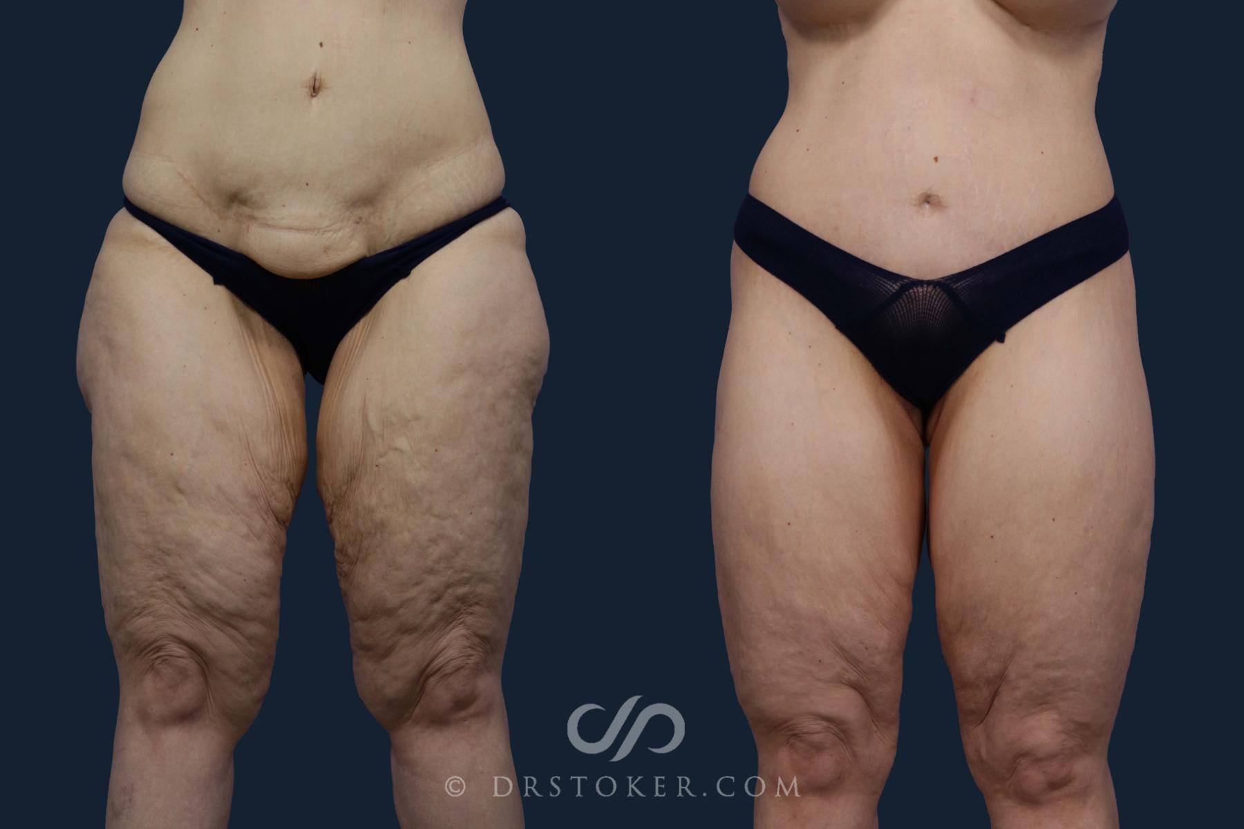 Before & After Thigh lift Case 1984 Front View in Los Angeles, CA