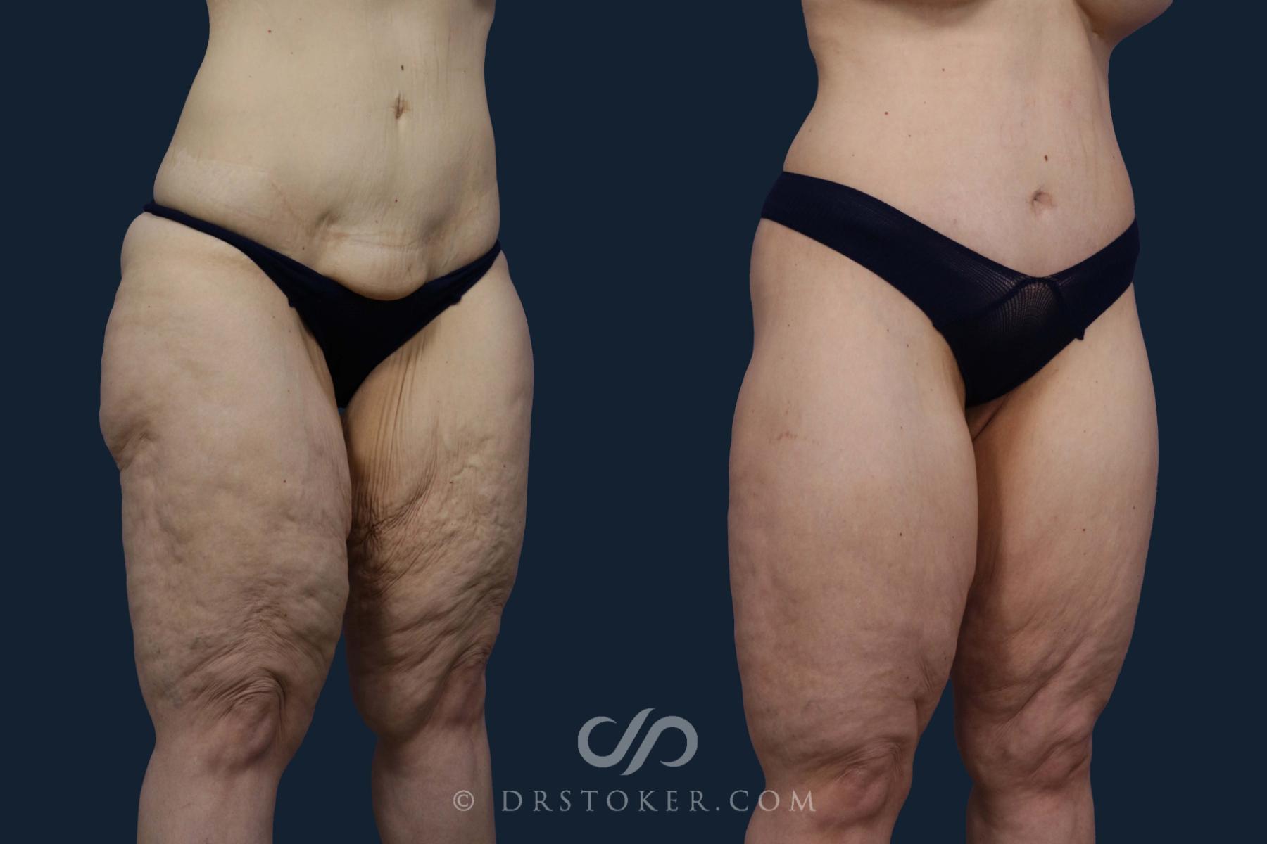 Before & After Thigh lift Case 1985 Right Oblique View in Los Angeles, CA