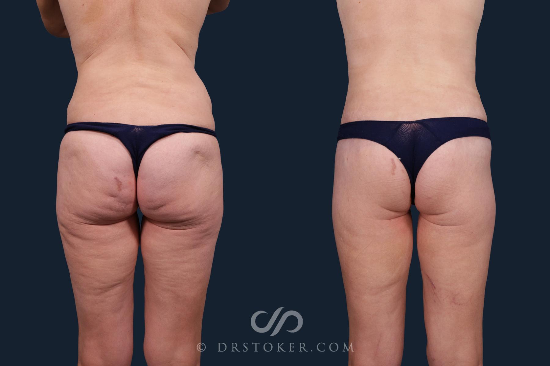 Before & After Thigh lift Case 2168 Back View in Los Angeles, CA