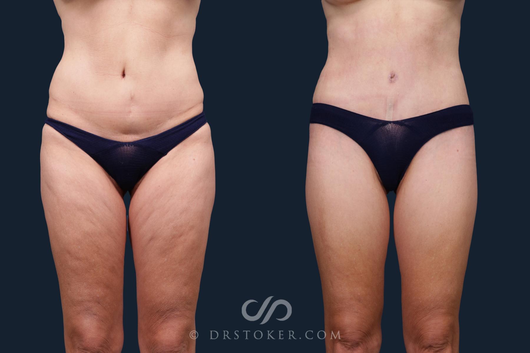 Before & After Thigh lift Case 2168 Front View in Los Angeles, CA