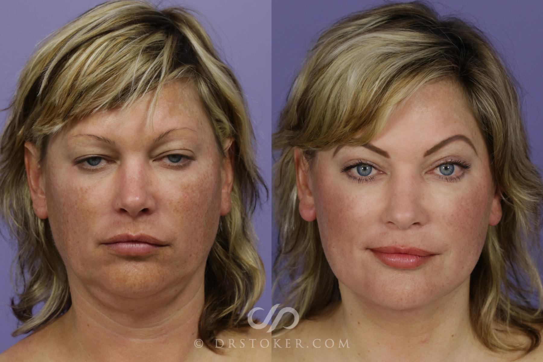 Before & After Traceless Deep Plane Facelift Case 1299 View #1 View in Los Angeles, CA