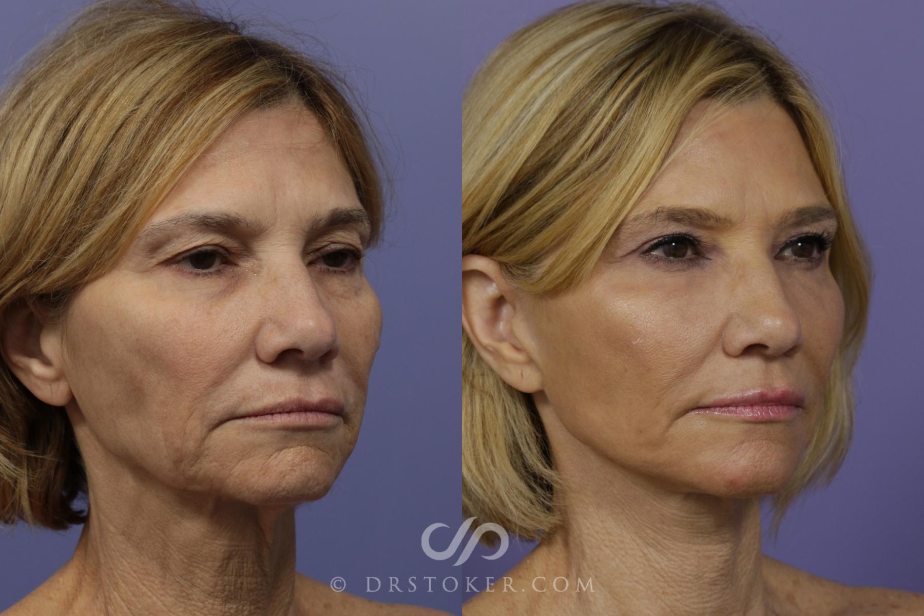 Before & After Traceless Deep Plane Facelift Case 1428 View #2 View in Los Angeles, CA