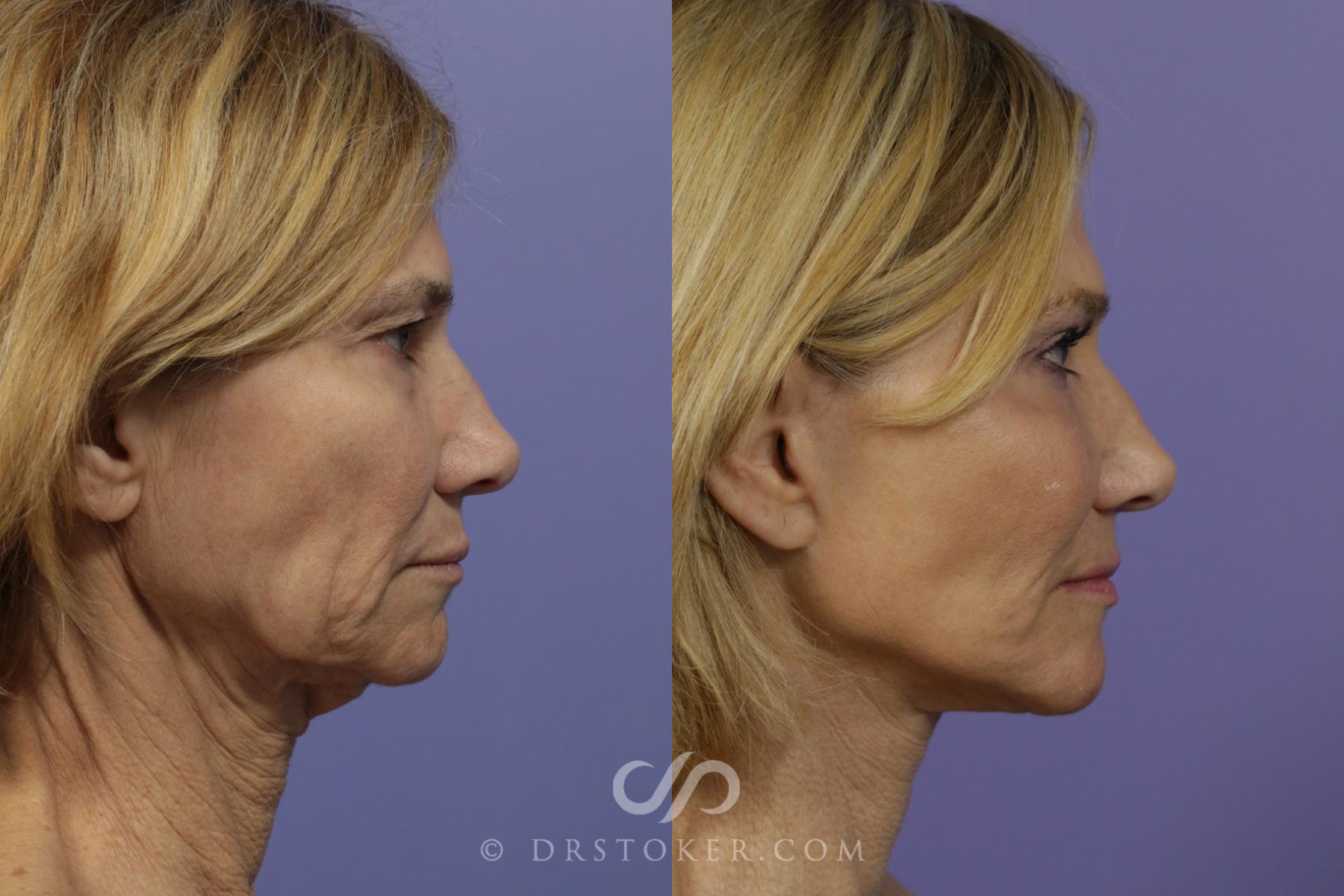 Before & After Traceless Deep Plane Facelift Case 1428 View #3 View in Los Angeles, CA