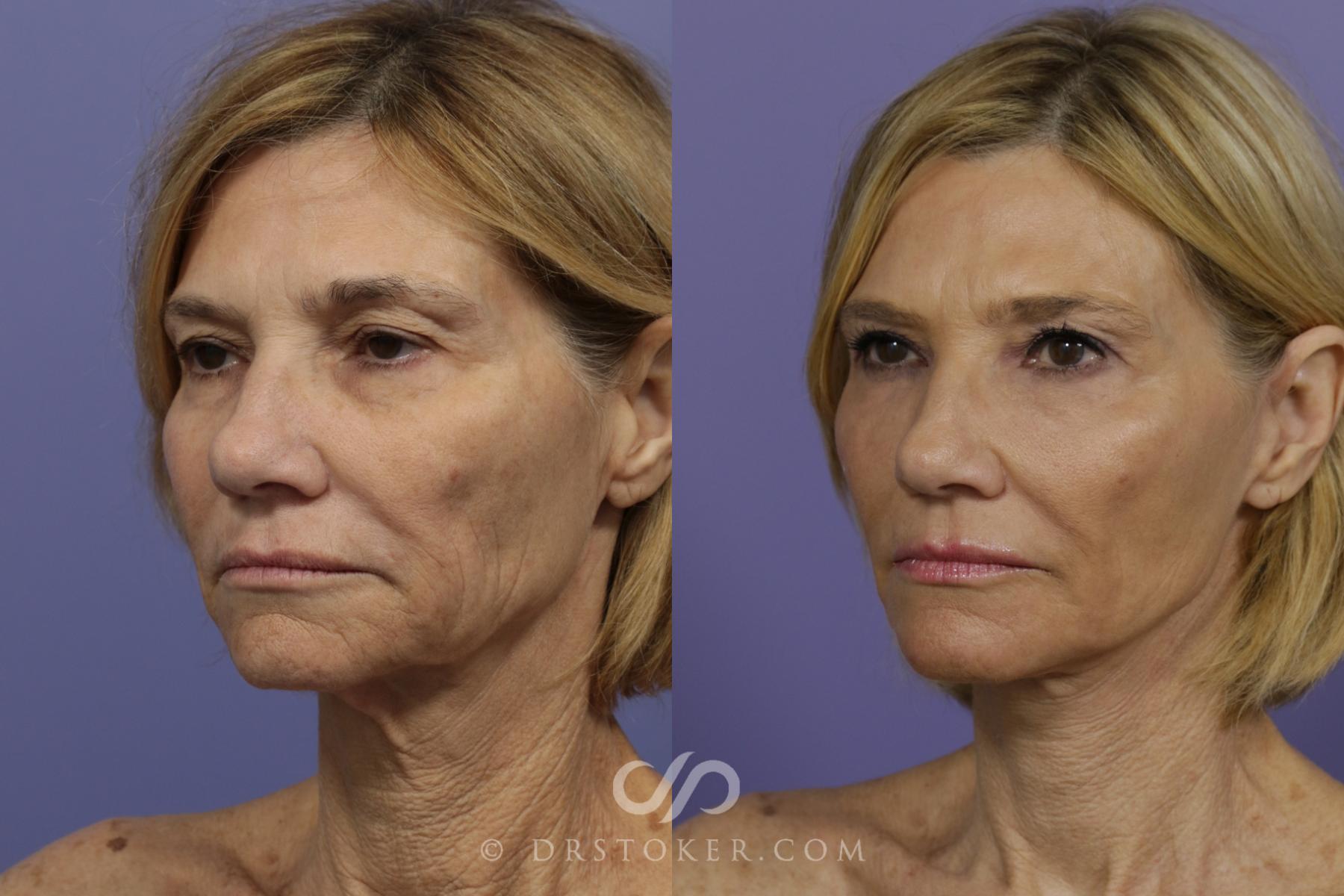 Before & After Traceless Deep Plane Facelift Case 1428 View #4 View in Los Angeles, CA