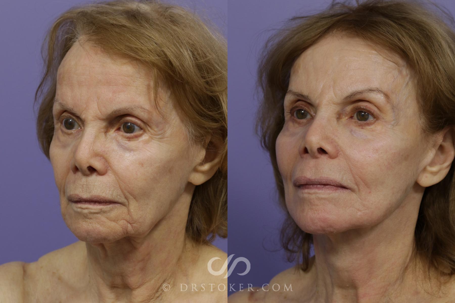 Before & After Traceless Deep Plane Facelift Case 1441 View #2 View in Los Angeles, CA