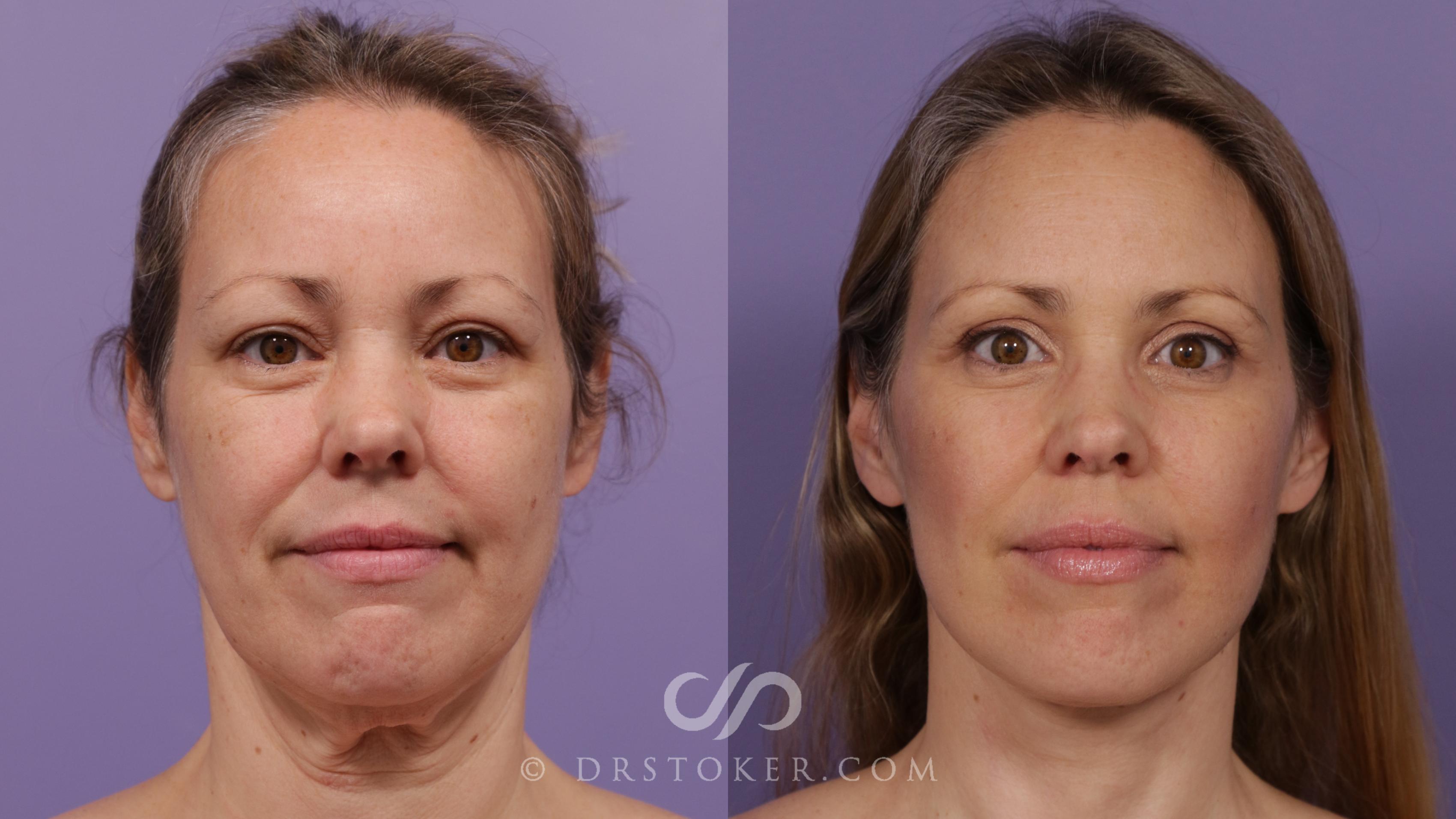 Before & After Traceless Deep Plane Facelift Case 1848 Front View in Los Angeles, CA