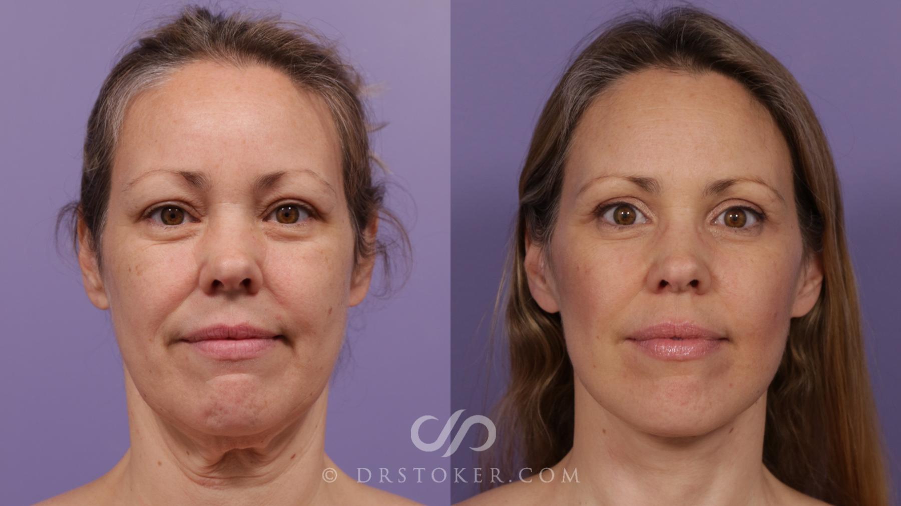 Before & After Traceless Deep Plane Facelift Case 1848 Front View in Los Angeles, CA