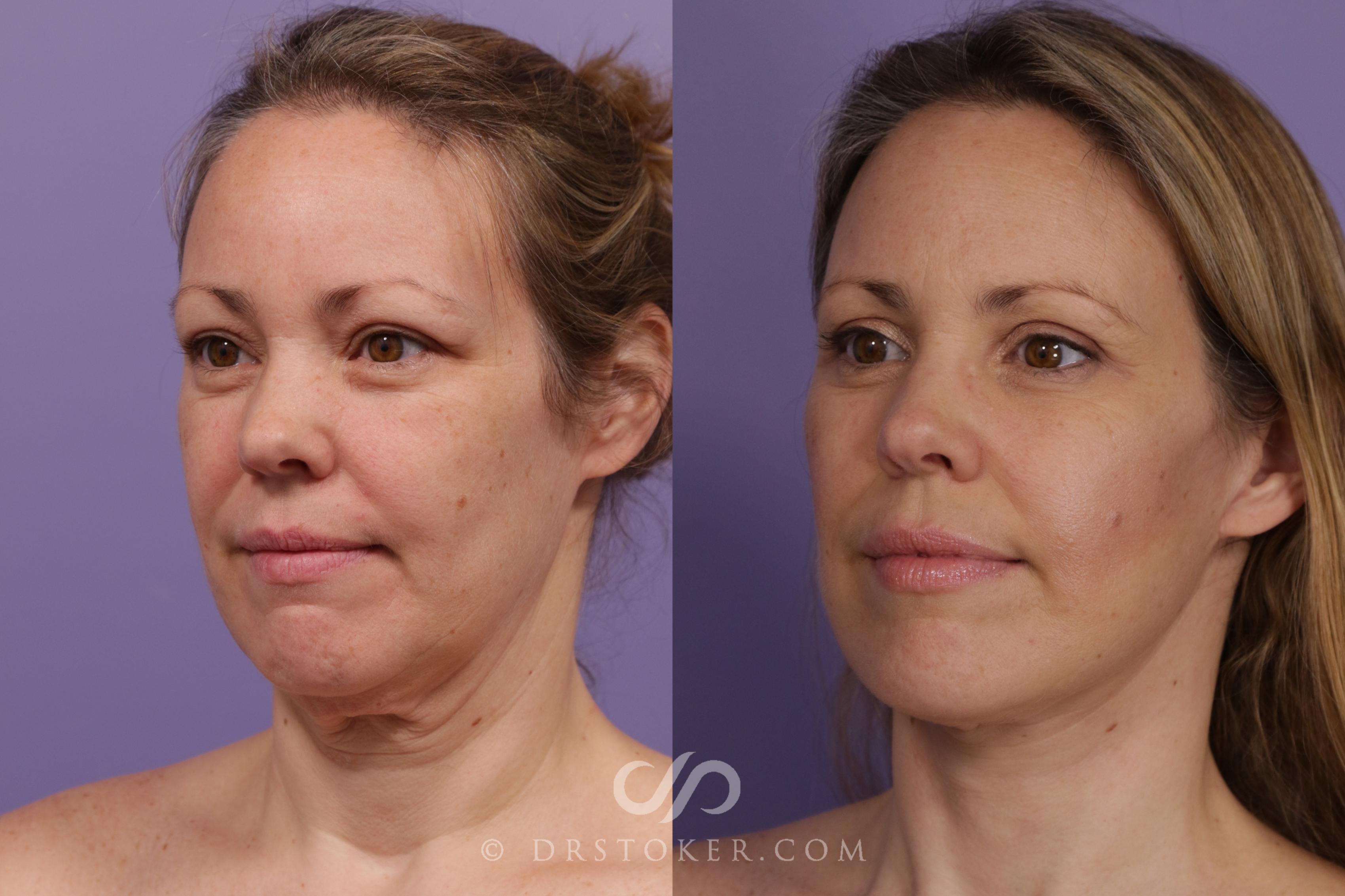 Before & After Traceless Deep Plane Facelift Case 1848 Left Oblique View in Los Angeles, CA