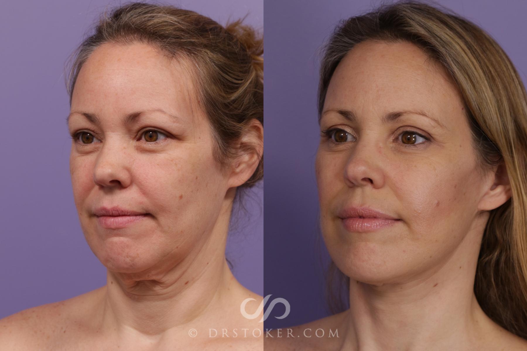 Before & After Traceless Deep Plane Facelift Case 1848 Left Oblique View in Los Angeles, CA