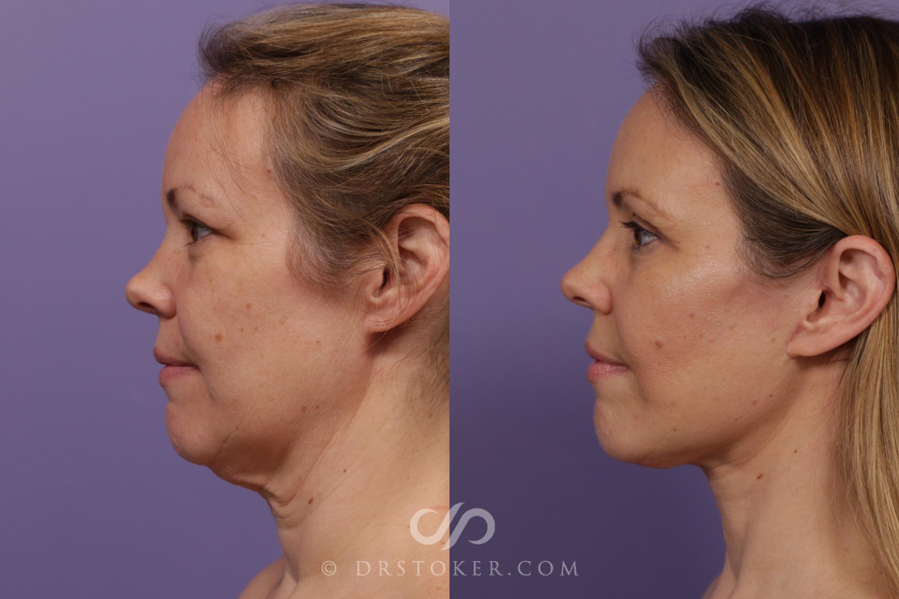 Before & After Traceless Deep Plane Facelift Case 1848 Left Side View in Los Angeles, CA