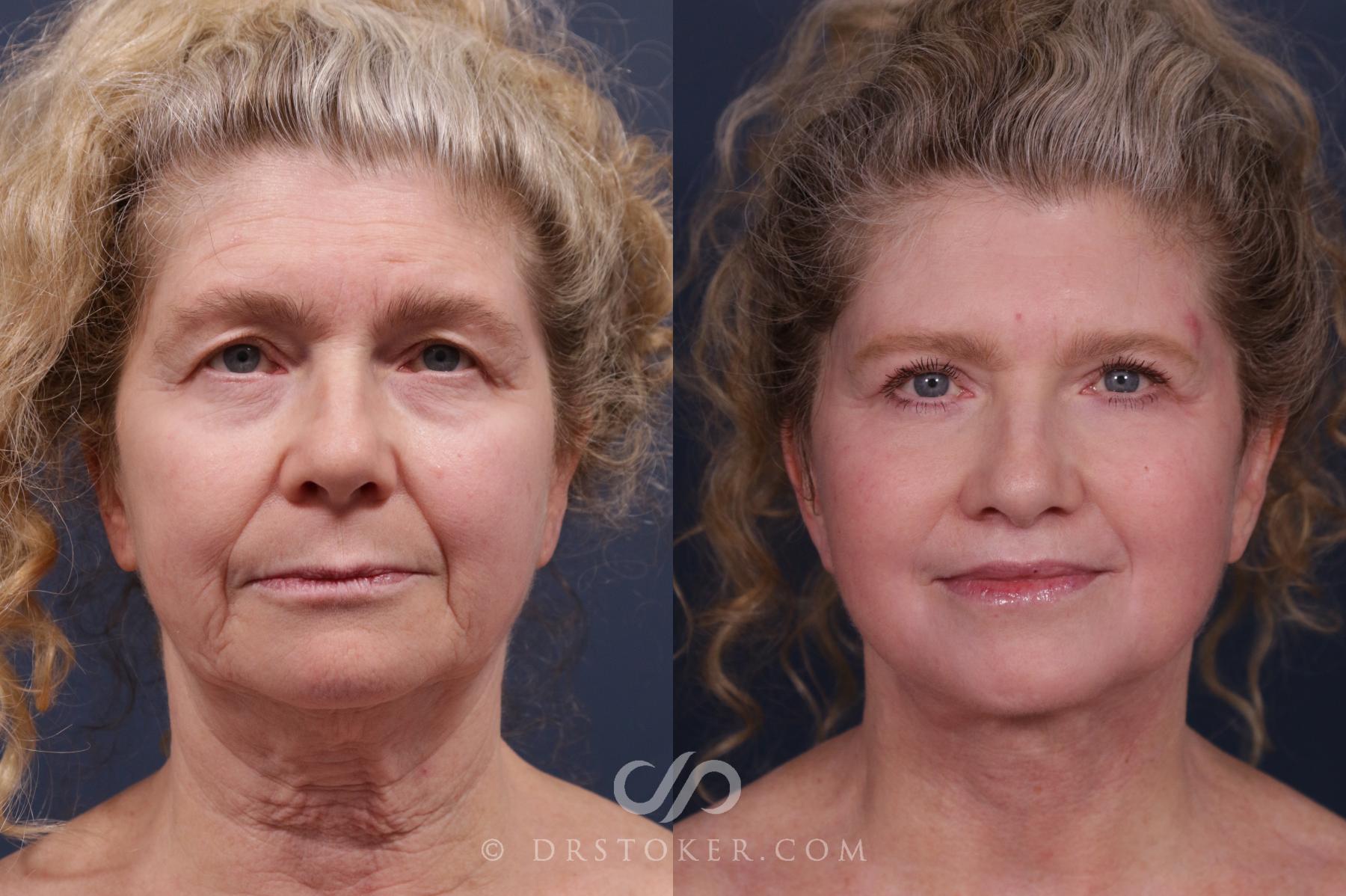Before & After Traceless Deep Plane Facelift Case 2157 Front View in Los Angeles, CA