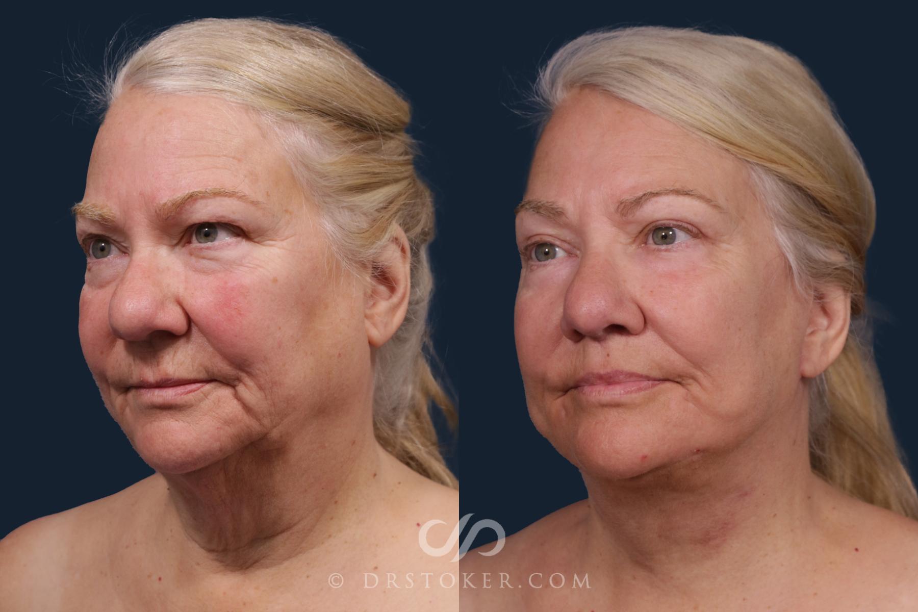 Before & After Traceless Deep Plane Facelift Case 2178 Left Oblique View in Los Angeles, CA