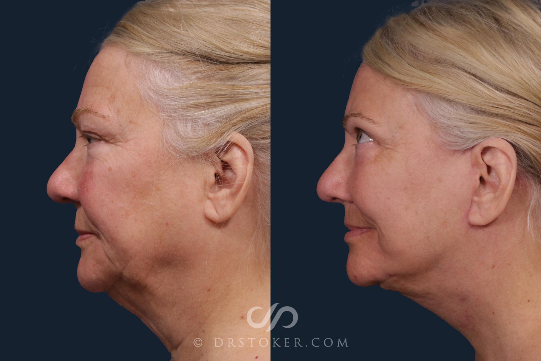 Before & After Traceless Deep Plane Facelift Case 2178 Left Side View in Los Angeles, CA