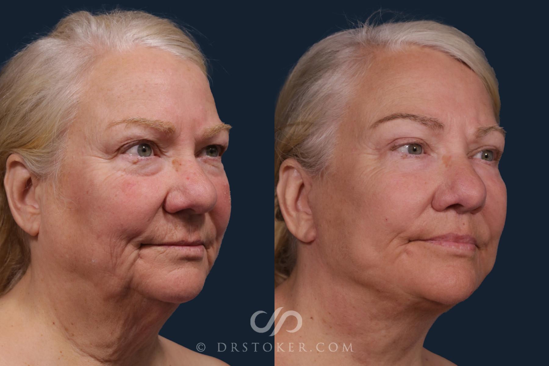 Before & After Traceless Deep Plane Facelift Case 2178 Right Oblique View in Los Angeles, CA