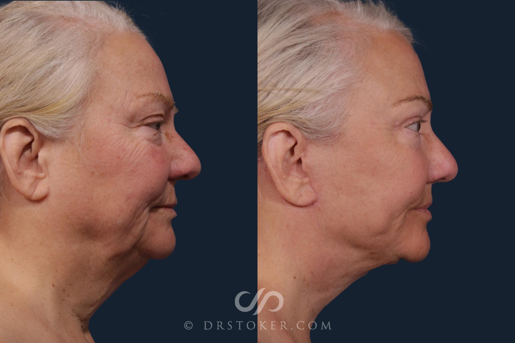 Before & After Traceless Deep Plane Facelift Case 2178 Right Side View in Los Angeles, CA