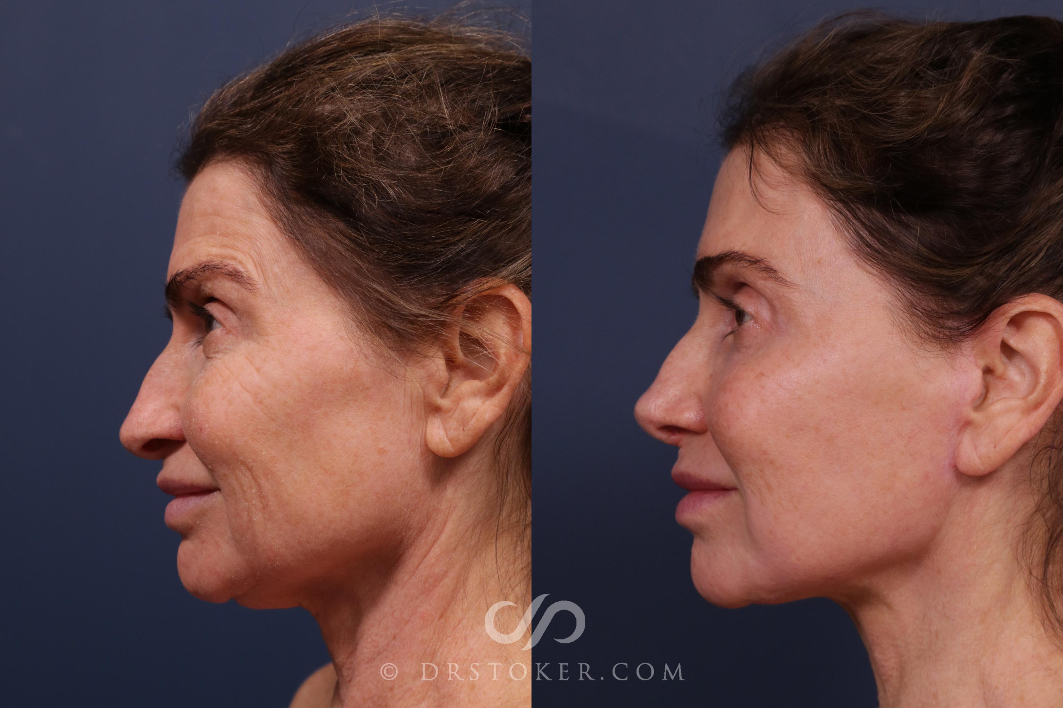 Before & After Traceless Deep Plane Facelift Case 2219 Left Side View in Los Angeles, CA