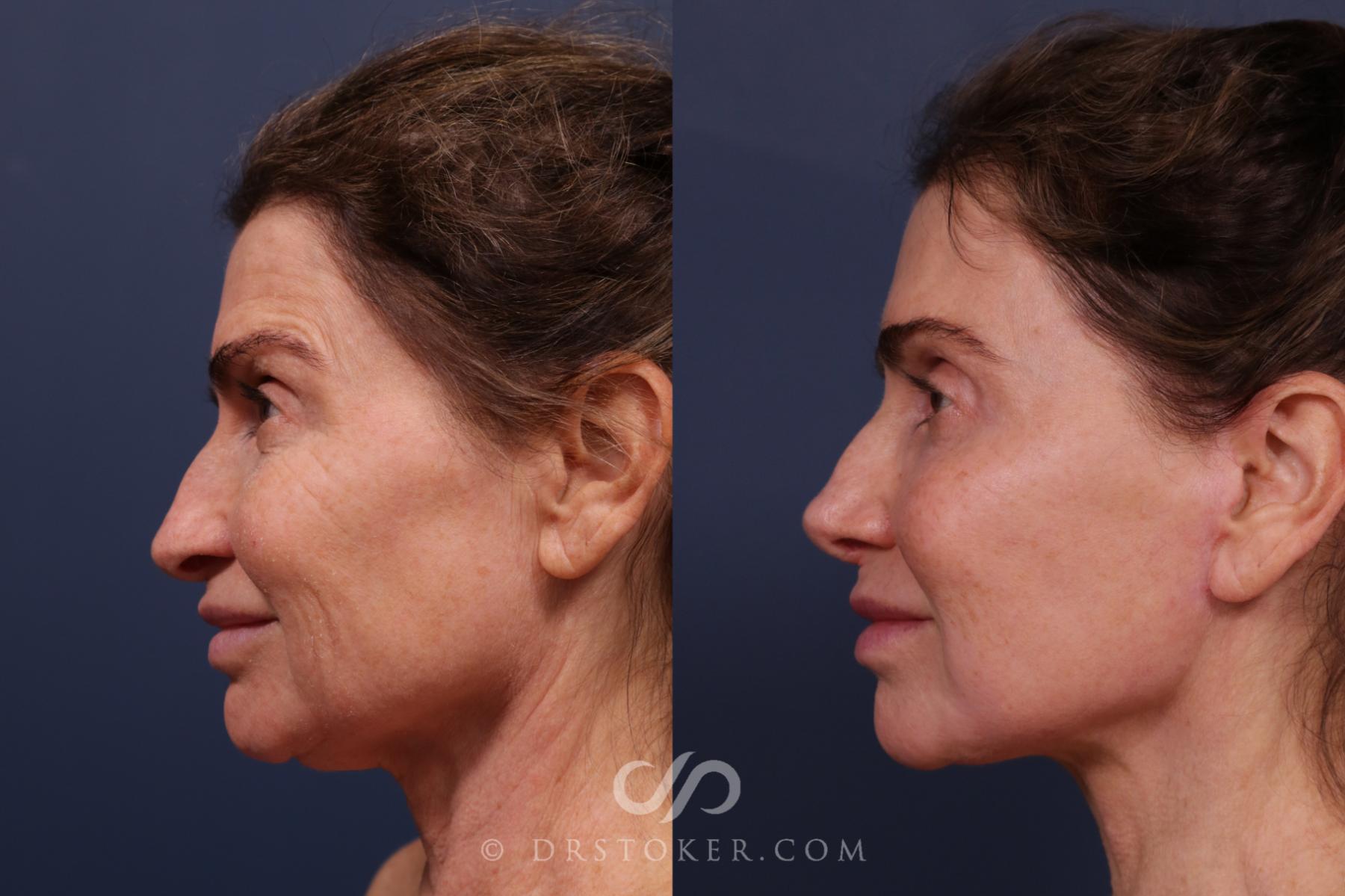 Before & After Traceless Deep Plane Facelift Case 2219 Left Side View in Los Angeles, CA
