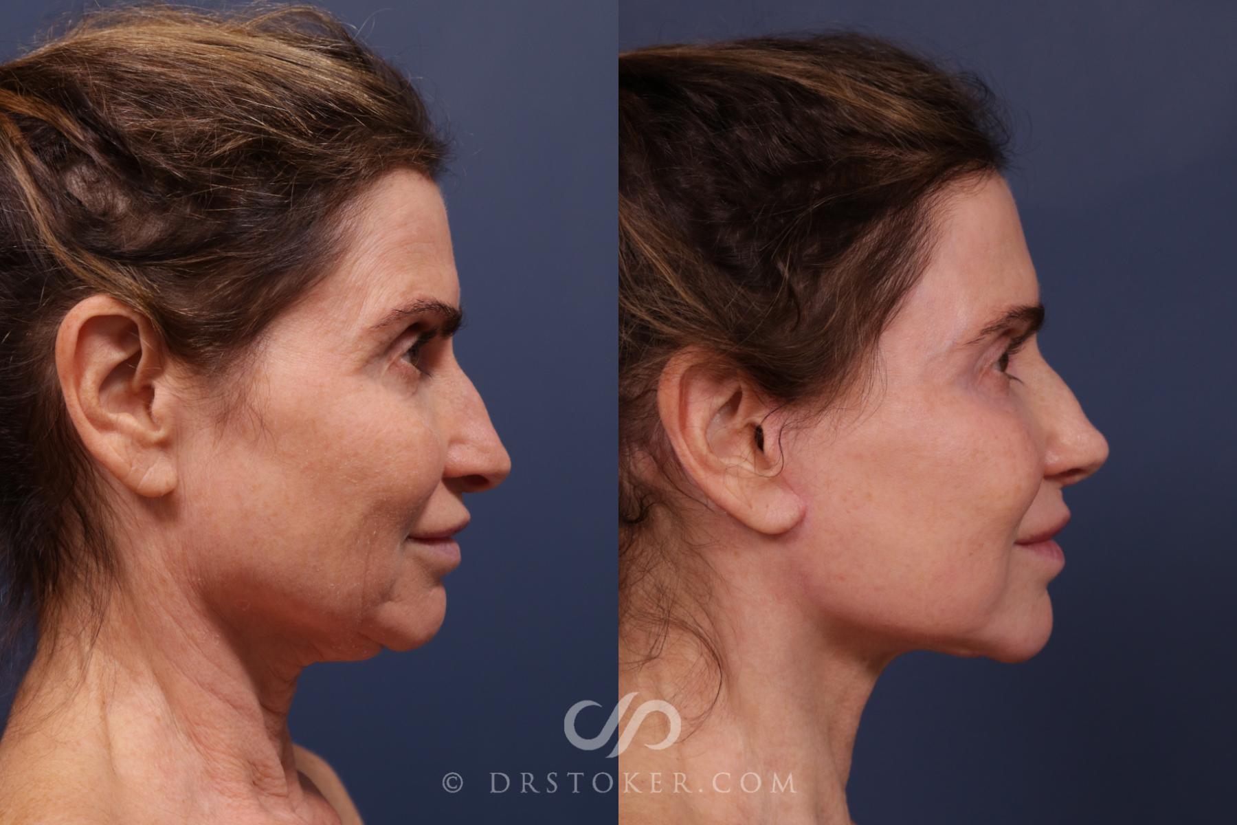 Before & After Traceless Deep Plane Facelift Case 2219 Right Side View in Los Angeles, CA