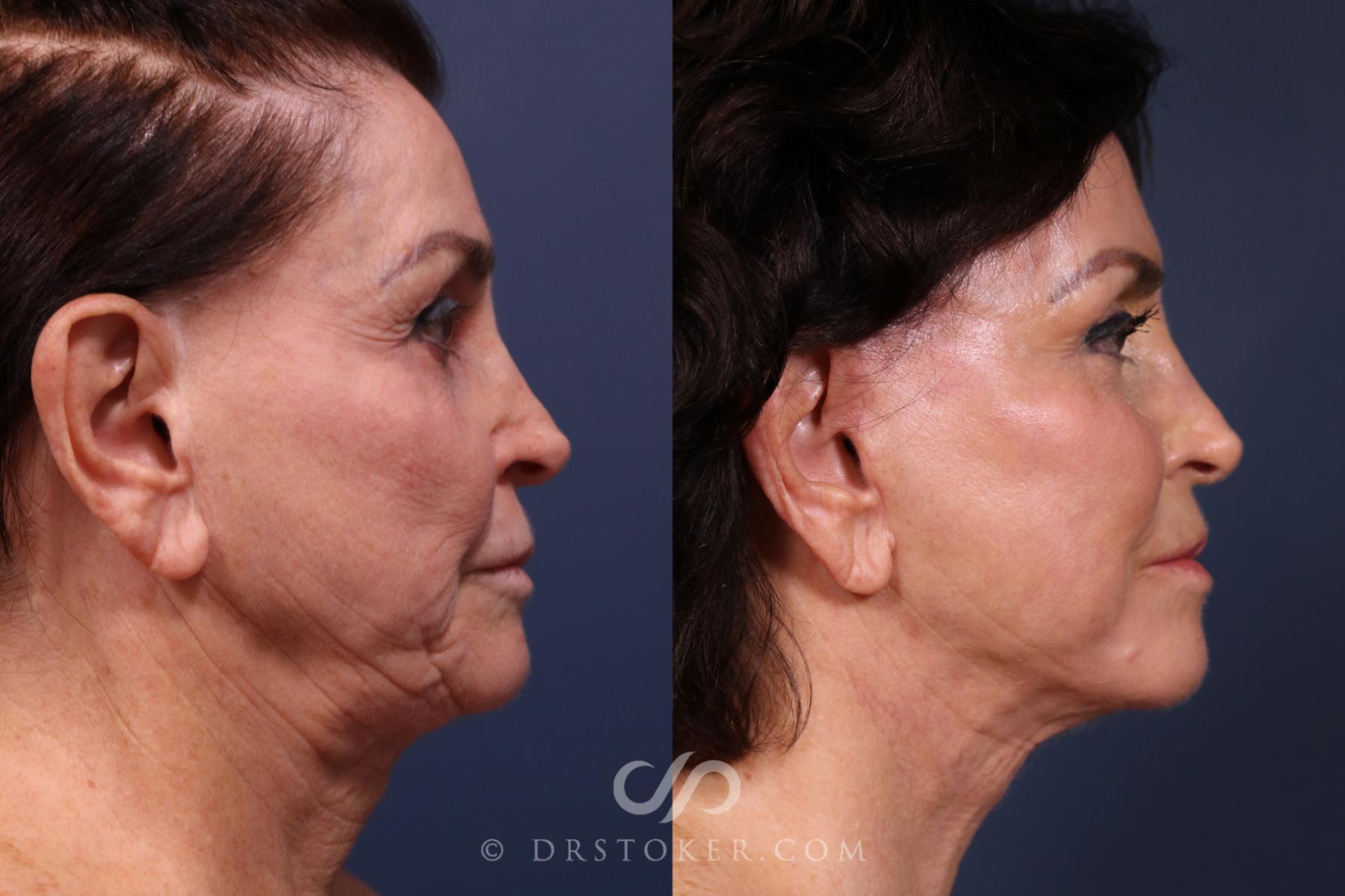 Before & After Traceless Deep Plane Facelift Case 2339 Right Side View in Los Angeles, CA