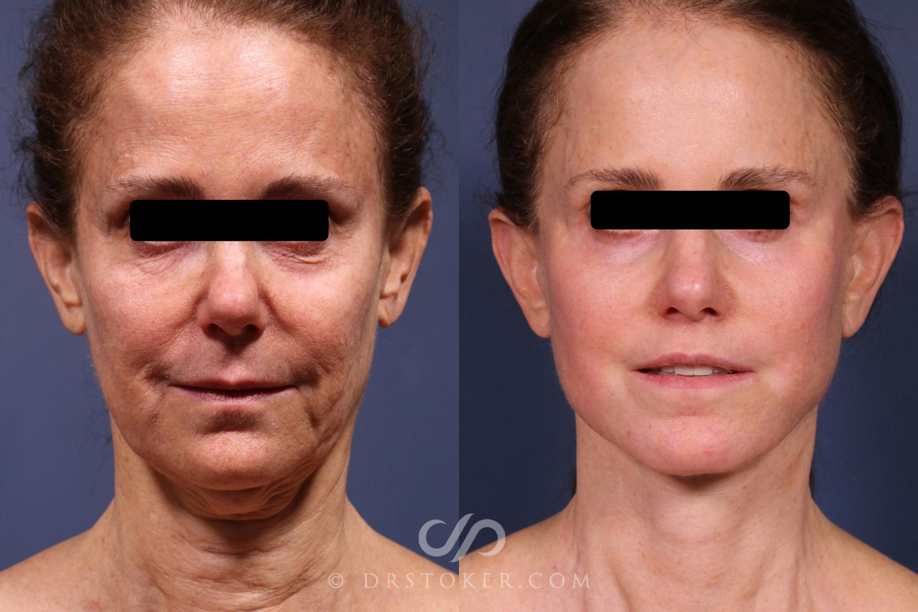 Before & After Neck Lift - Traceless Neck Lift  Case 2373 Front View in Los Angeles, CA