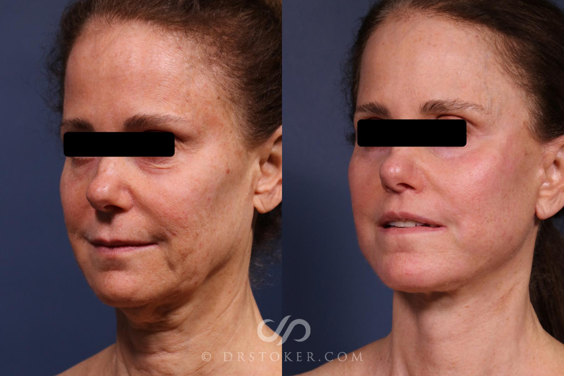 Before & After Traceless Deep Plane Facelift Case 2373 Left Oblique View in Los Angeles, CA