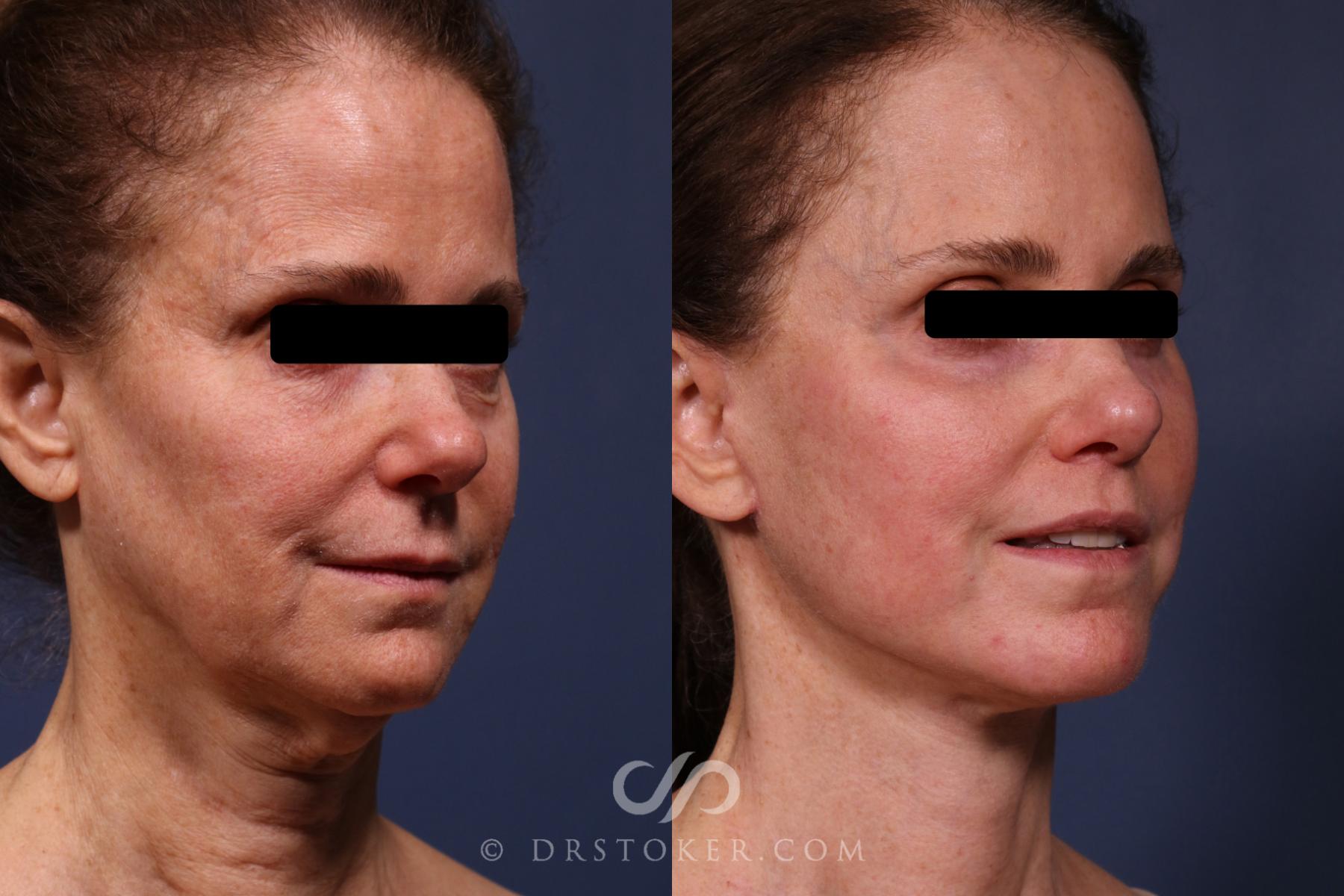 Before & After Traceless Deep Plane Facelift Case 2373 Right Oblique View in Los Angeles, CA