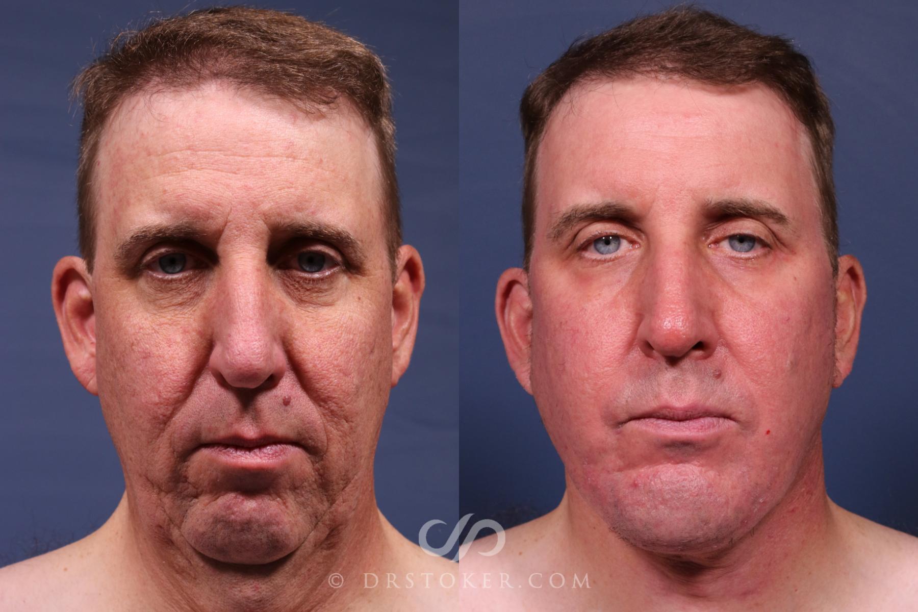 Before & After Traceless Deep Plane Facelift Case 2565 Front View in Los Angeles, CA