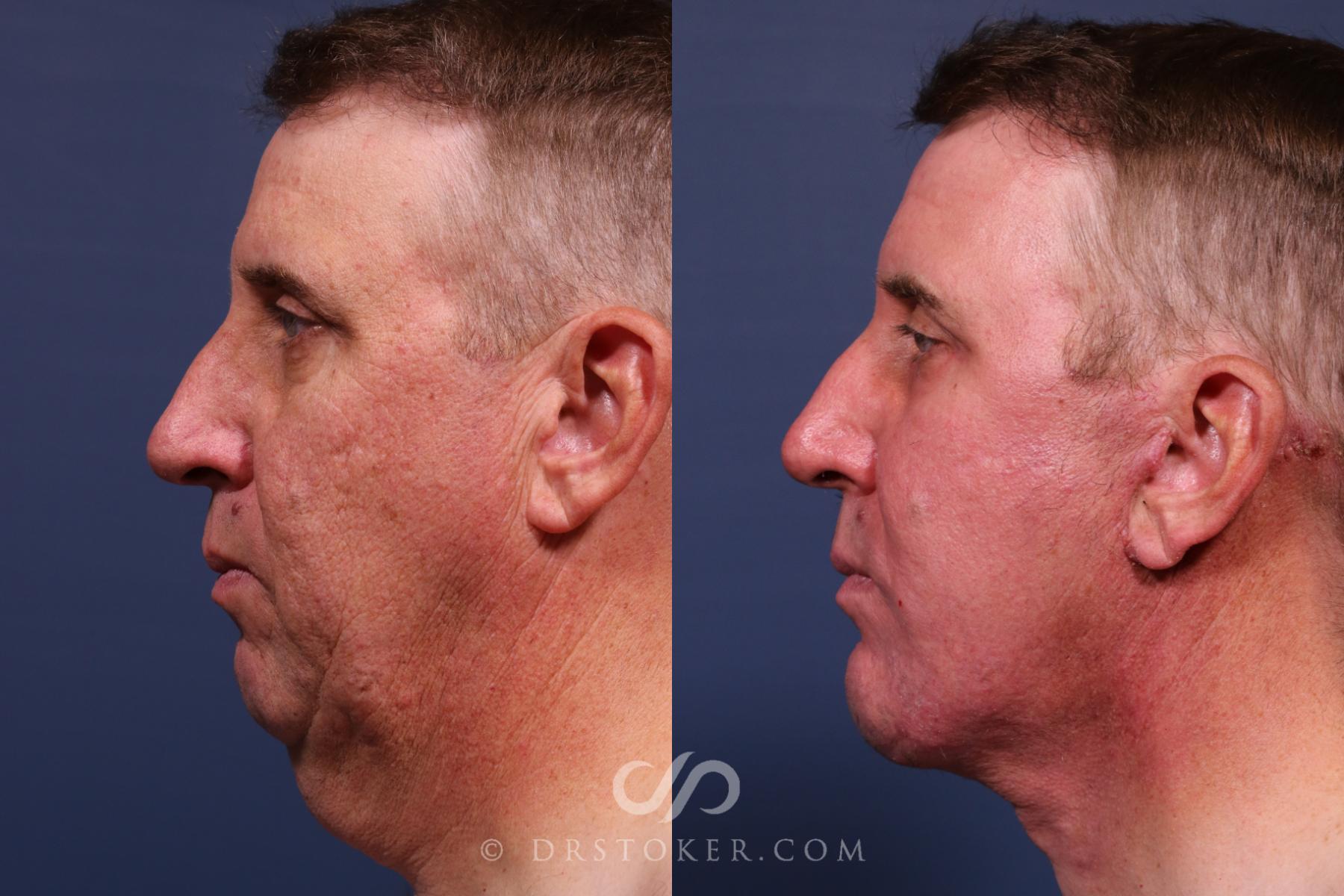 Before & After Traceless Deep Plane Facelift Case 2565 Left Side View in Los Angeles, CA