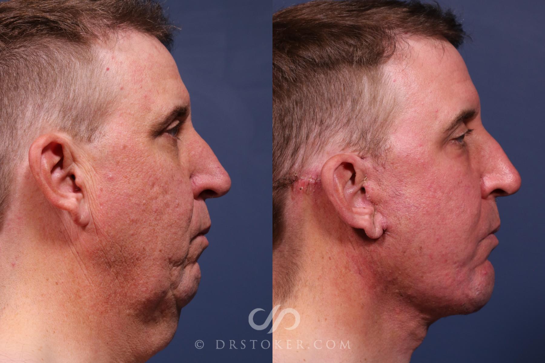 Before & After Traceless Deep Plane Facelift Case 2565 Right Side View in Los Angeles, CA