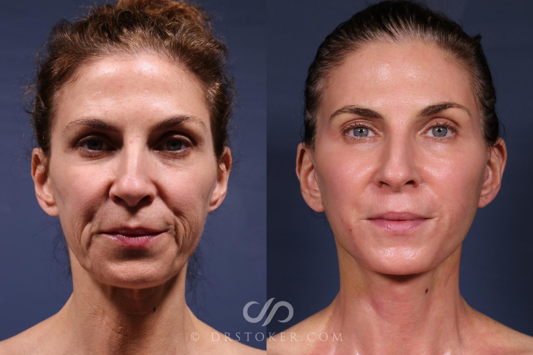 Before & After Traceless Deep Plane Facelift Case 2566 Front View in Los Angeles, CA