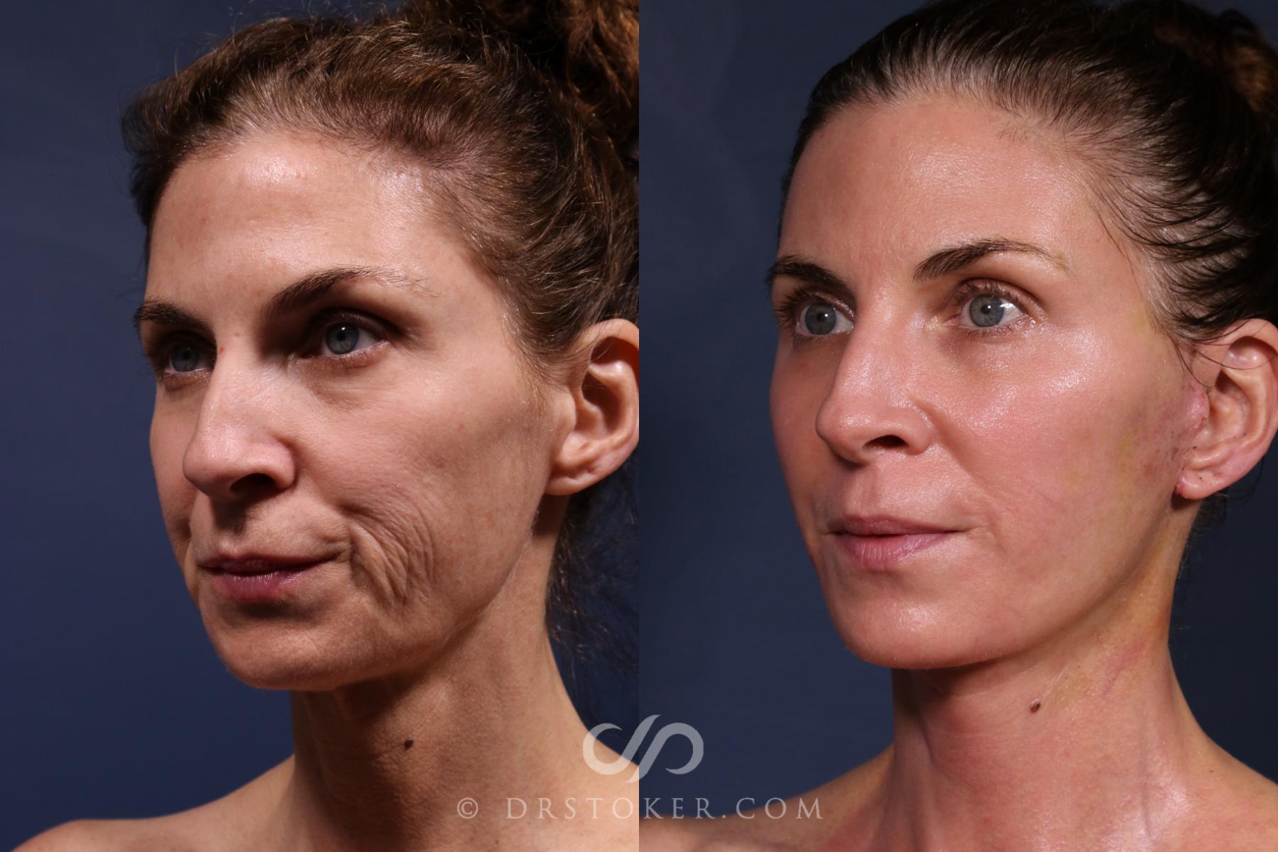 Before & After Traceless Deep Plane Facelift Case 2566 Left Side View in Los Angeles, CA