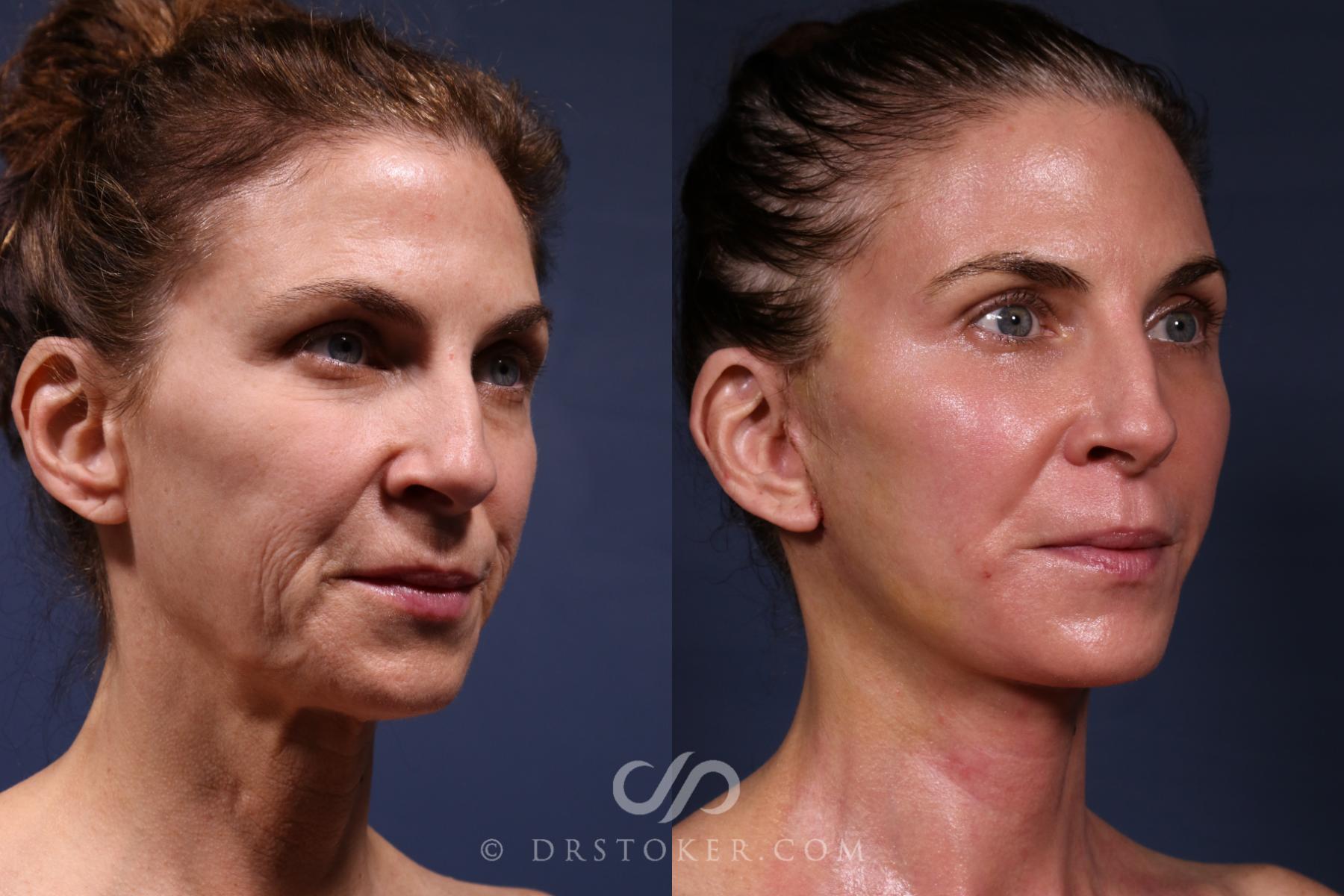 Before & After Traceless Deep Plane Facelift Case 2566 Right Oblique View in Los Angeles, CA