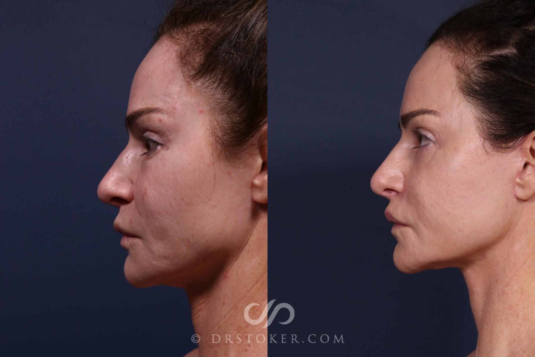 Before & After Traceless Deep Plane Facelift Case 2579 Front View in Los Angeles, CA