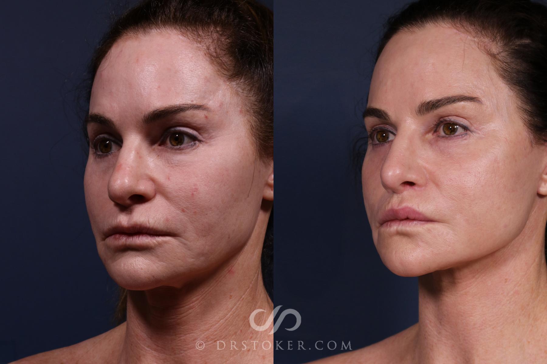Before & After Traceless Deep Plane Facelift Case 2579 Left Oblique View in Los Angeles, CA
