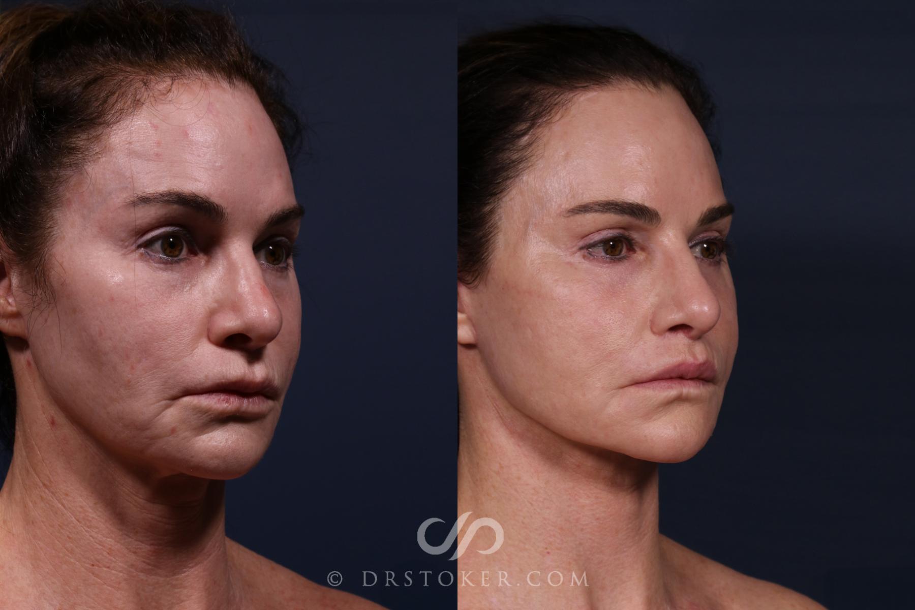 Before & After Traceless Deep Plane Facelift Case 2579 Right Oblique View in Los Angeles, CA