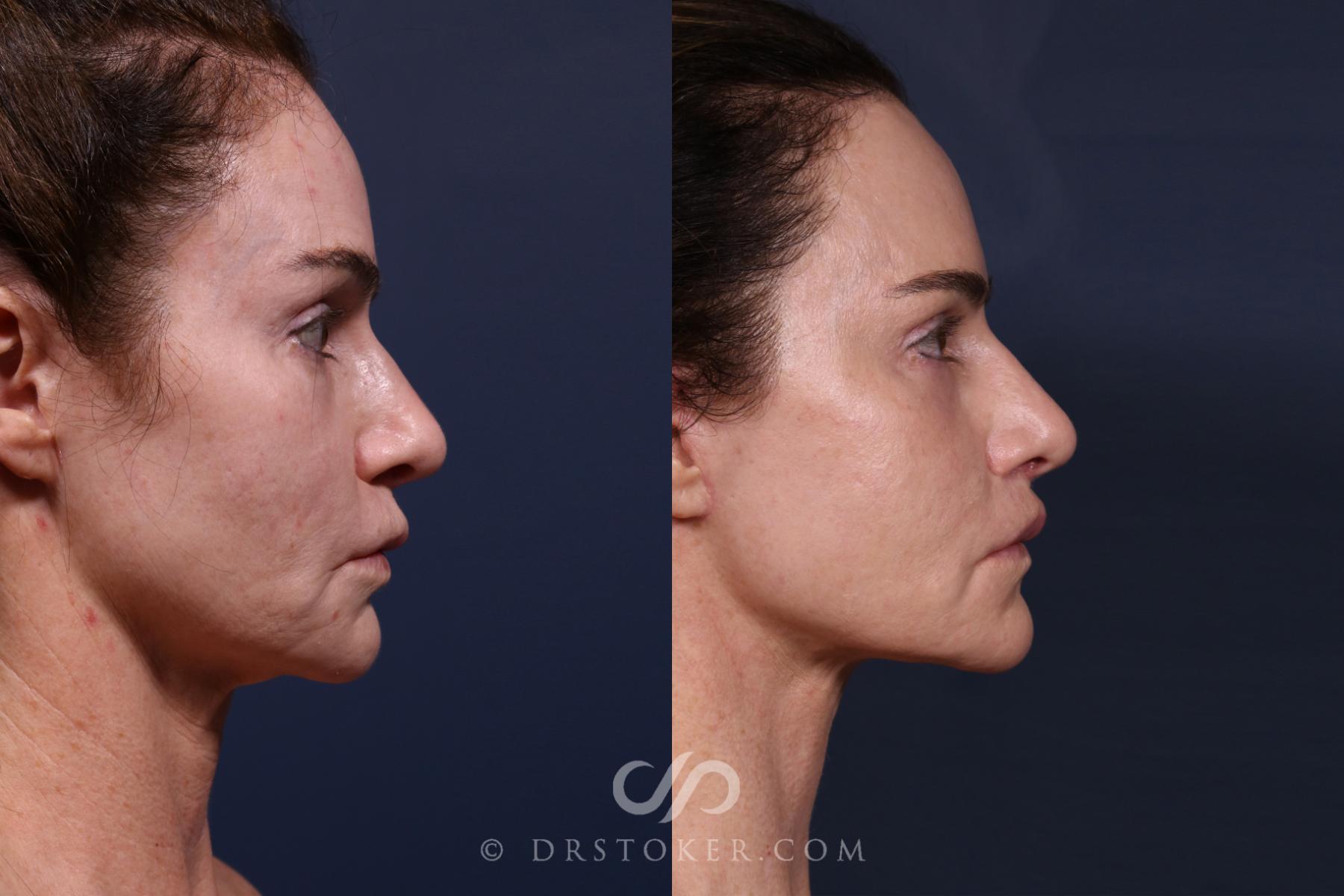 Before & After Traceless Deep Plane Facelift Case 2579 Right Side View in Los Angeles, CA
