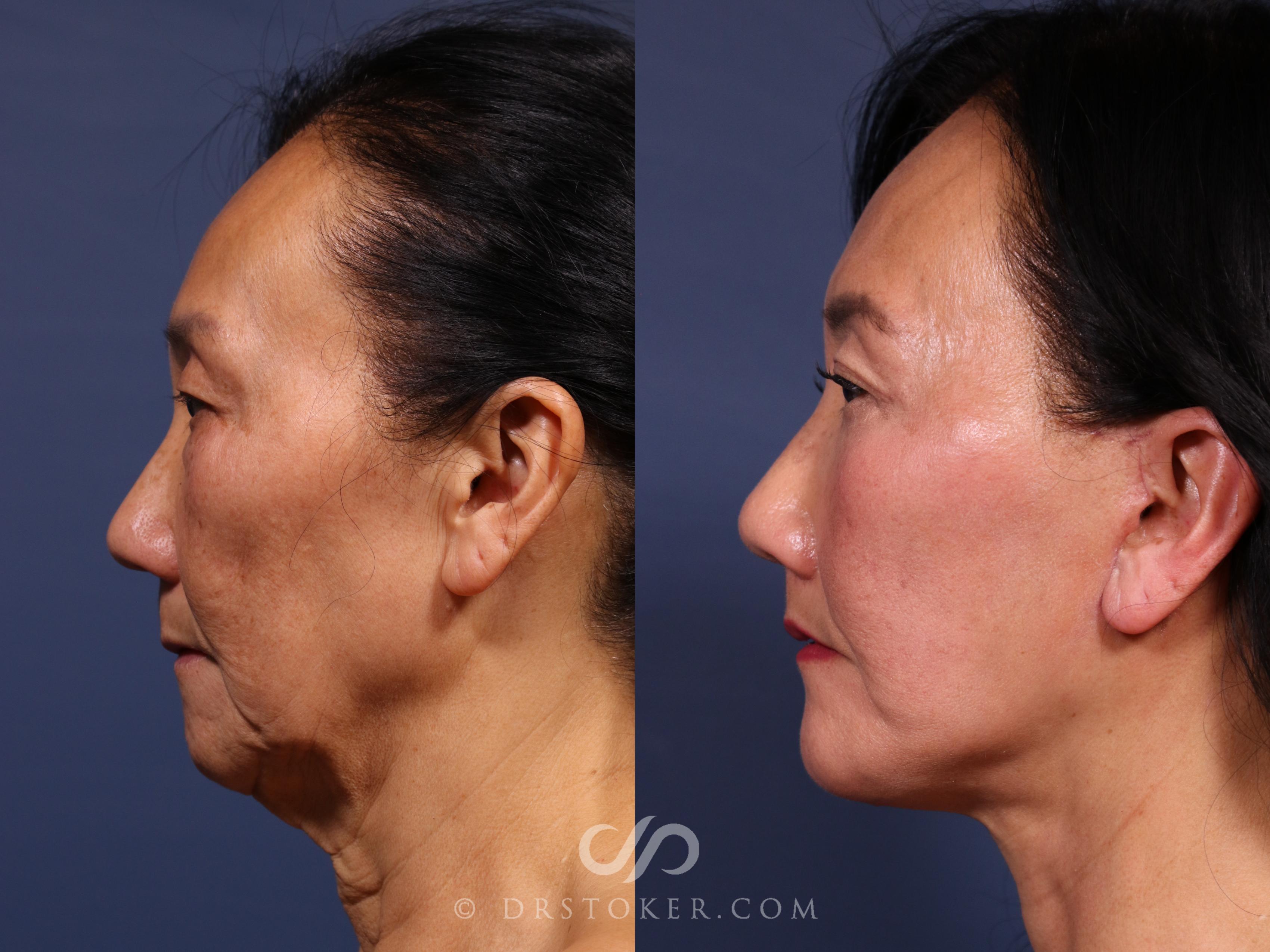 Before & After Traceless Deep Plane Facelift Case 2590 Left Side View in Los Angeles, CA