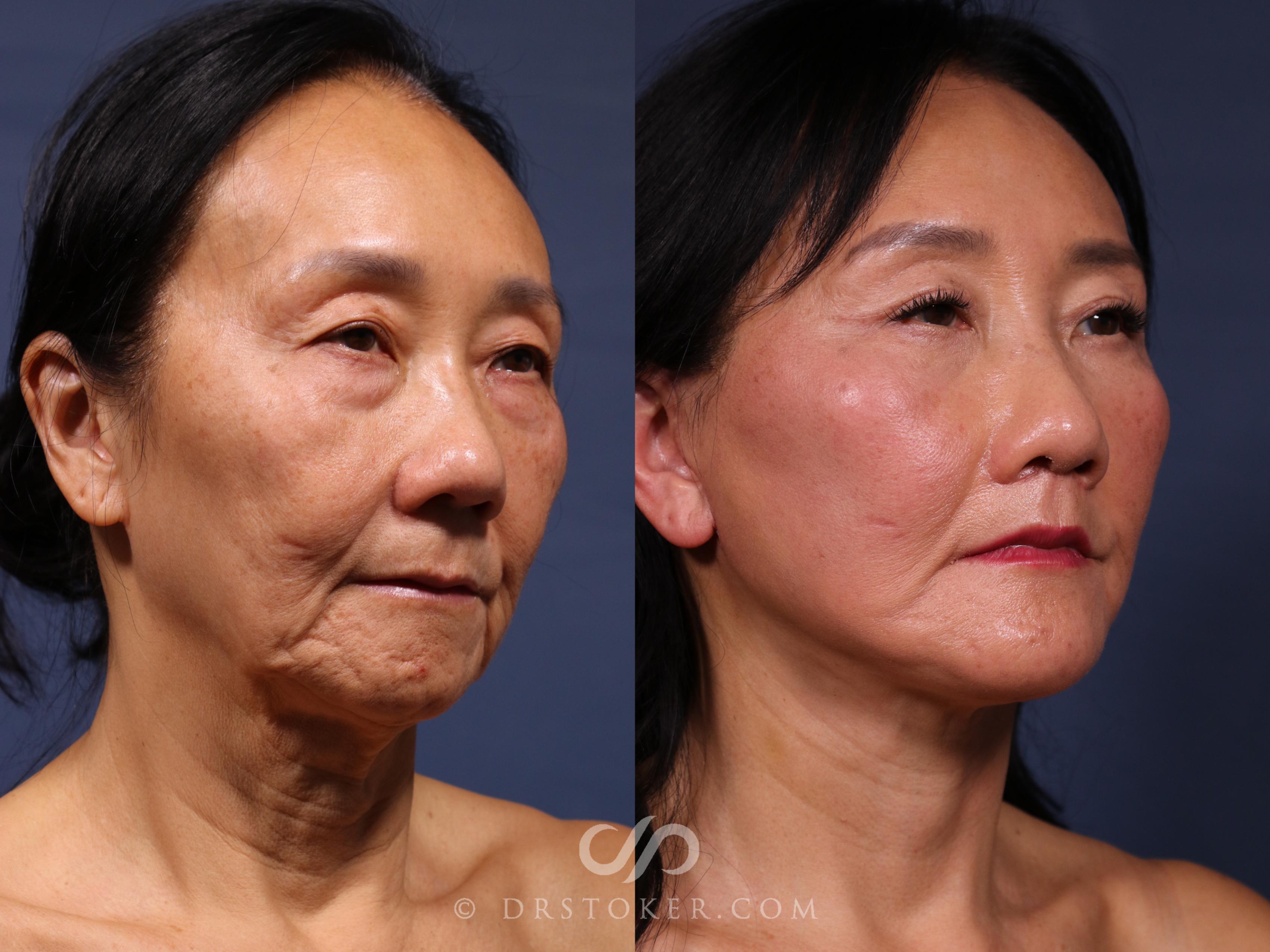 Before & After Traceless Deep Plane Facelift Case 2590 Right Oblique View in Los Angeles, CA