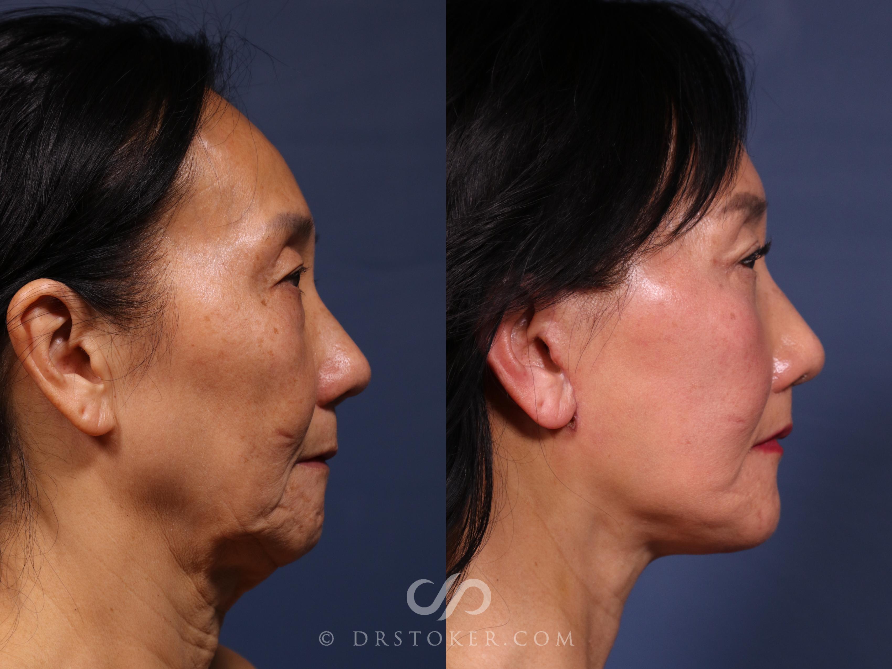 Before & After Traceless Deep Plane Facelift Case 2590 Right Side View in Los Angeles, CA