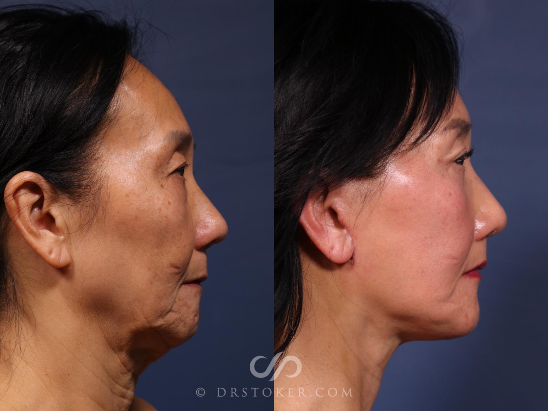 Before & After Laser Skin Resurfacing  Case 2590 Right Side View in Los Angeles, CA