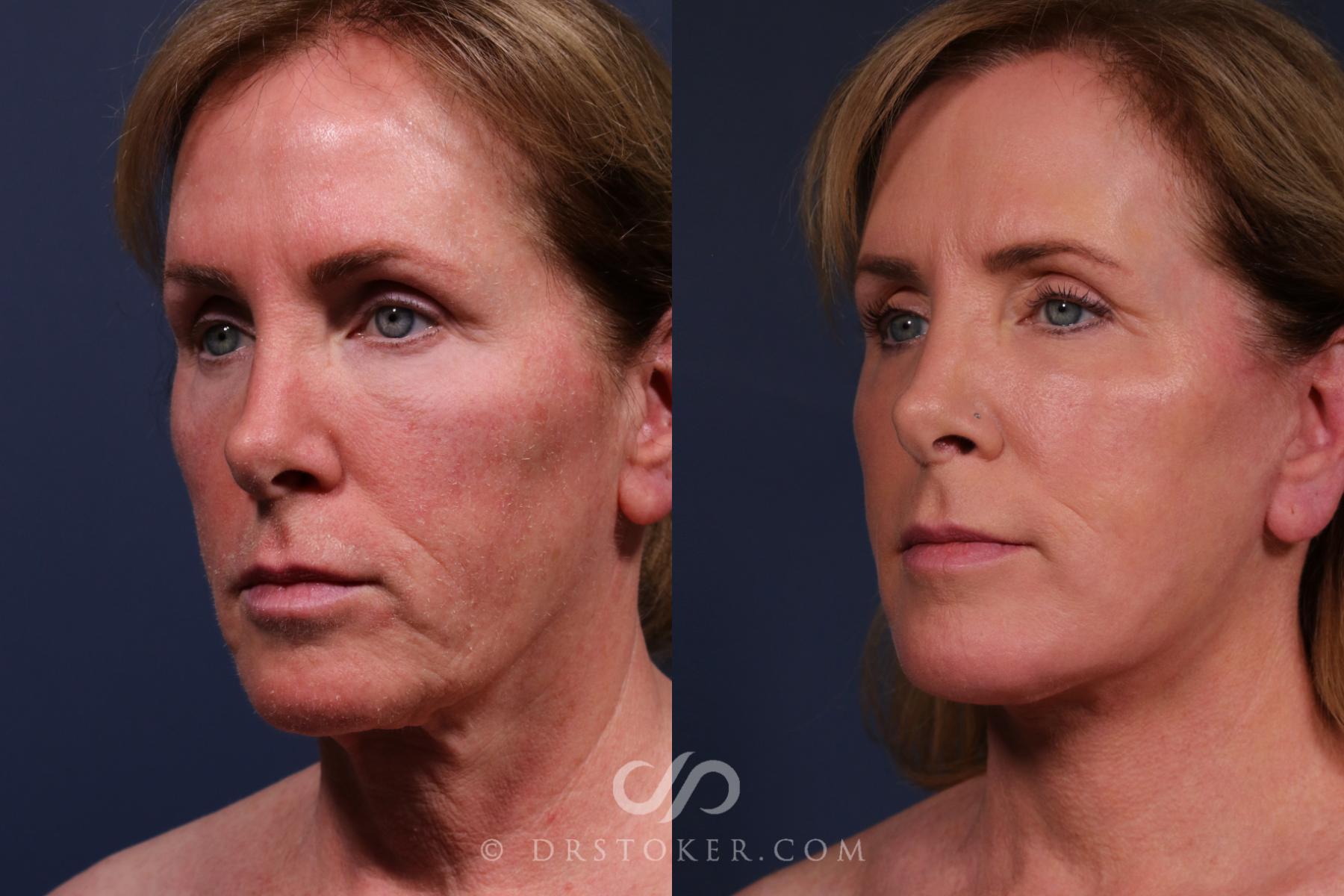 Before & After Traceless Deep Plane Facelift Case 2601 Left Oblique View in Los Angeles, CA